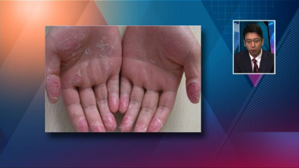 【杏林在線】手指甩皮點算好？