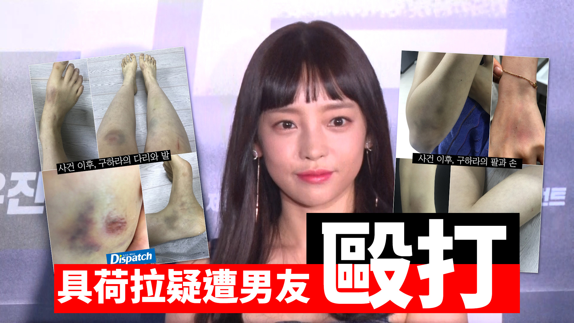 具荷拉公開全身瘀傷照 疑遭男友毆打致子宮出血