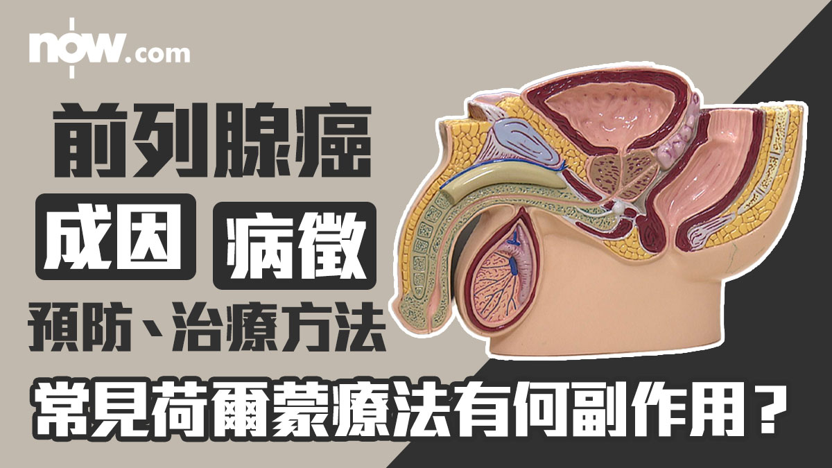 前列腺癌成因／病徵／預防、治療方法一覽　常見荷爾蒙療法有何副作用？