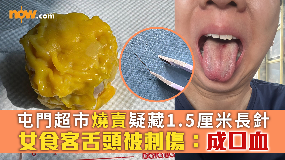 食物安全｜屯門超市燒賣疑藏1.5厘米長針　女食客舌頭被刺傷：成口血
