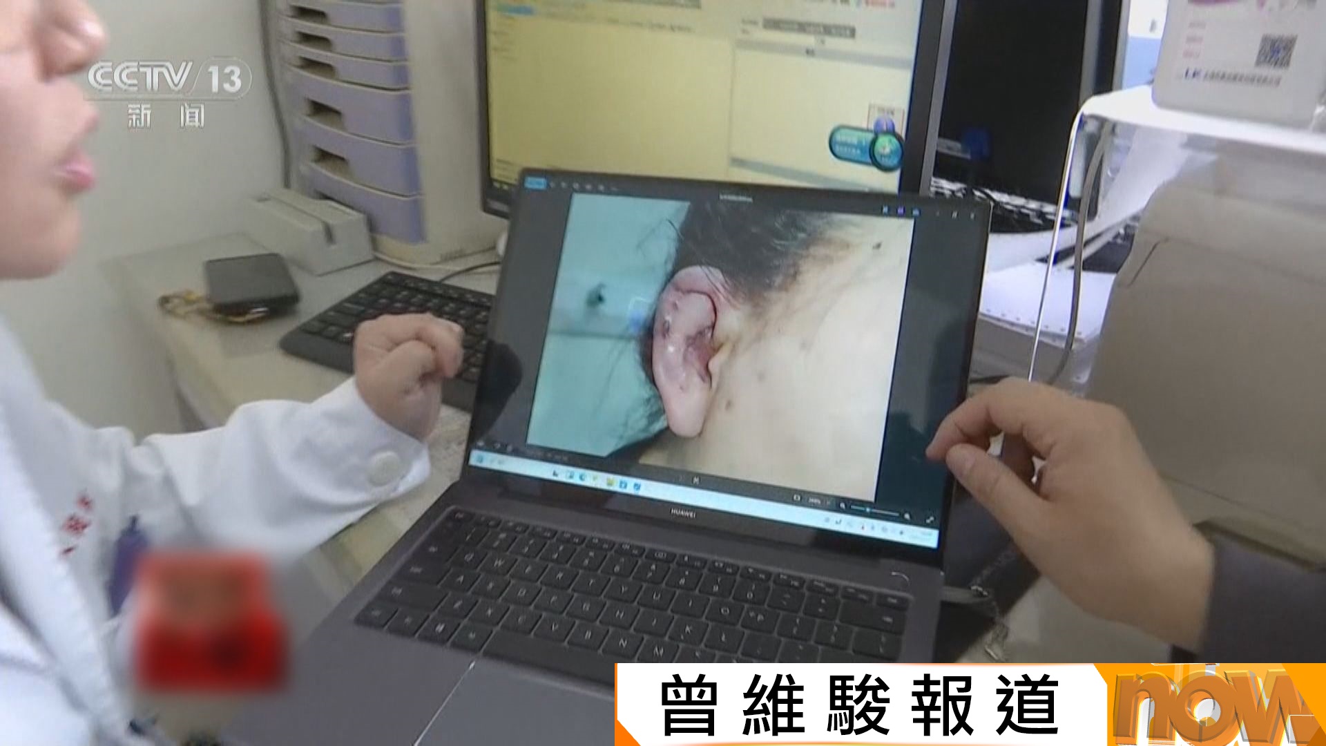 內地掀「精靈耳」整形歪風　風險極高可致面癱失明