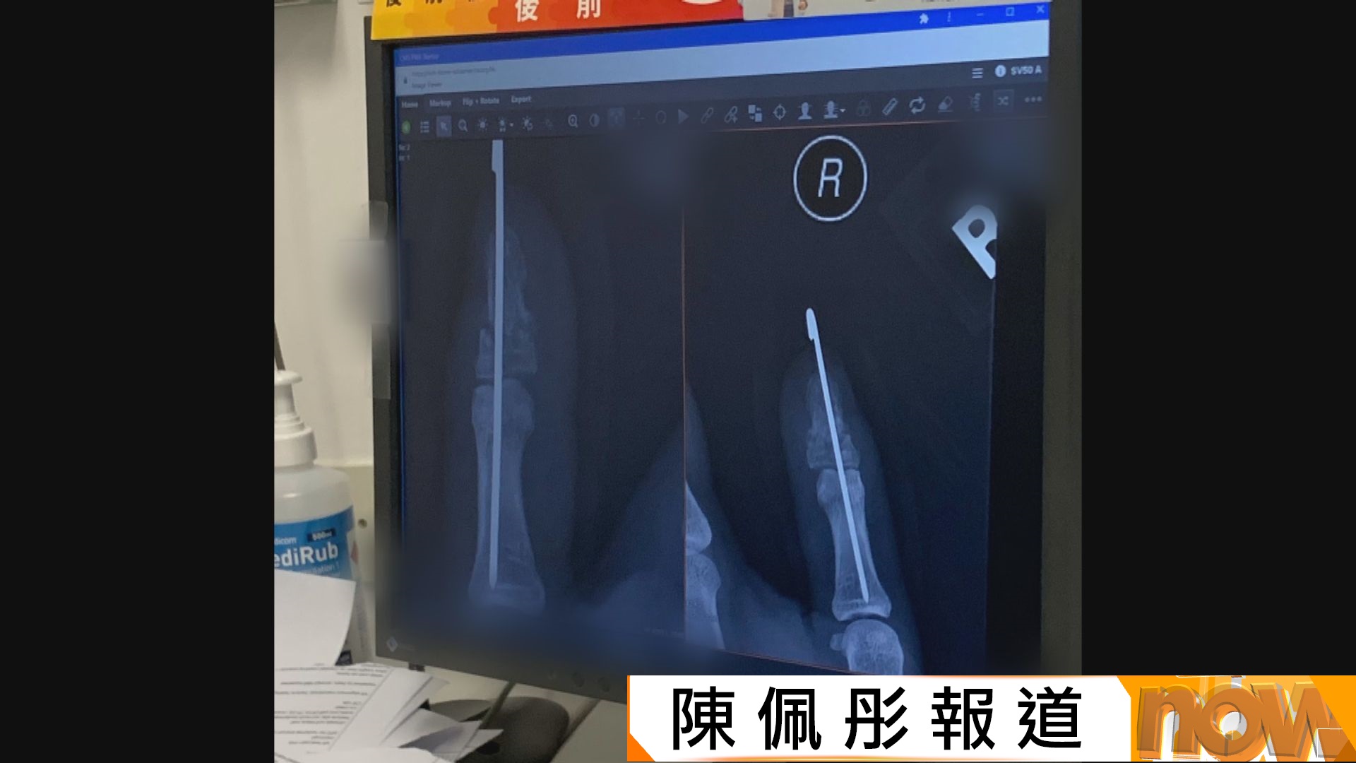 外賣員斷手指僅獲2700元賠償　工會倡以一個月或一年平均收入計算賠償