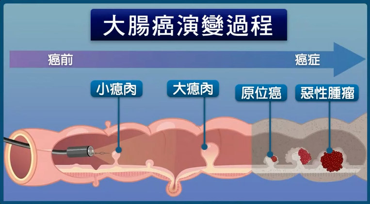 東野圭吾據報因患大腸癌病逝　醫生詳解成因及病徵　籲及早篩查防患未然