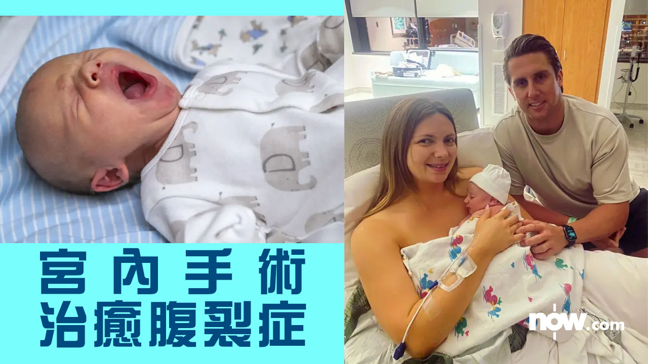 【醫學突破】英男嬰患罕見「腹裂症」腸臟外露　孕婦懷胎26周做宮內手術成功治癒