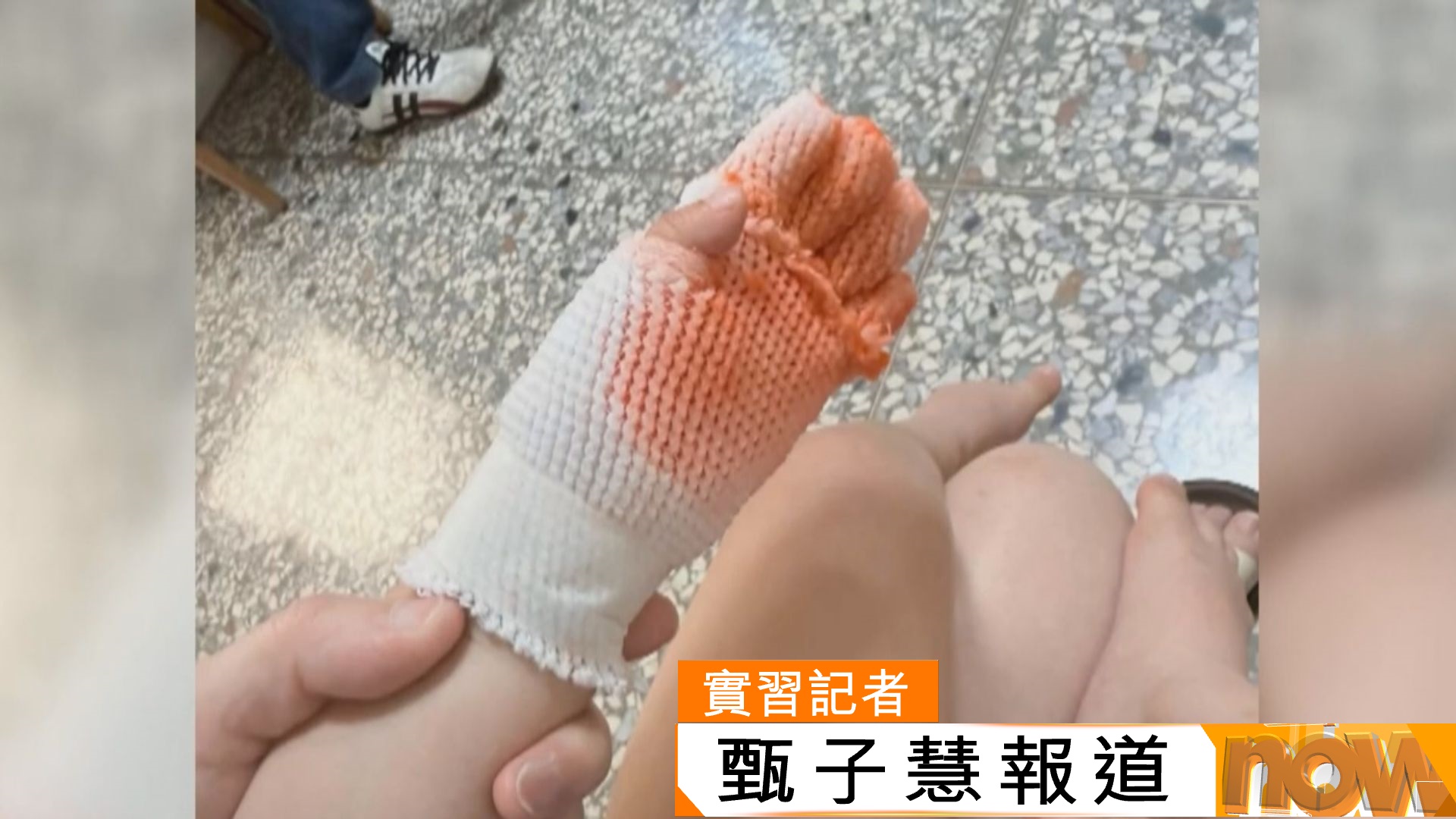 台灣炎熱　彰化縣兒童被滑板場金屬鐵板燙傷
