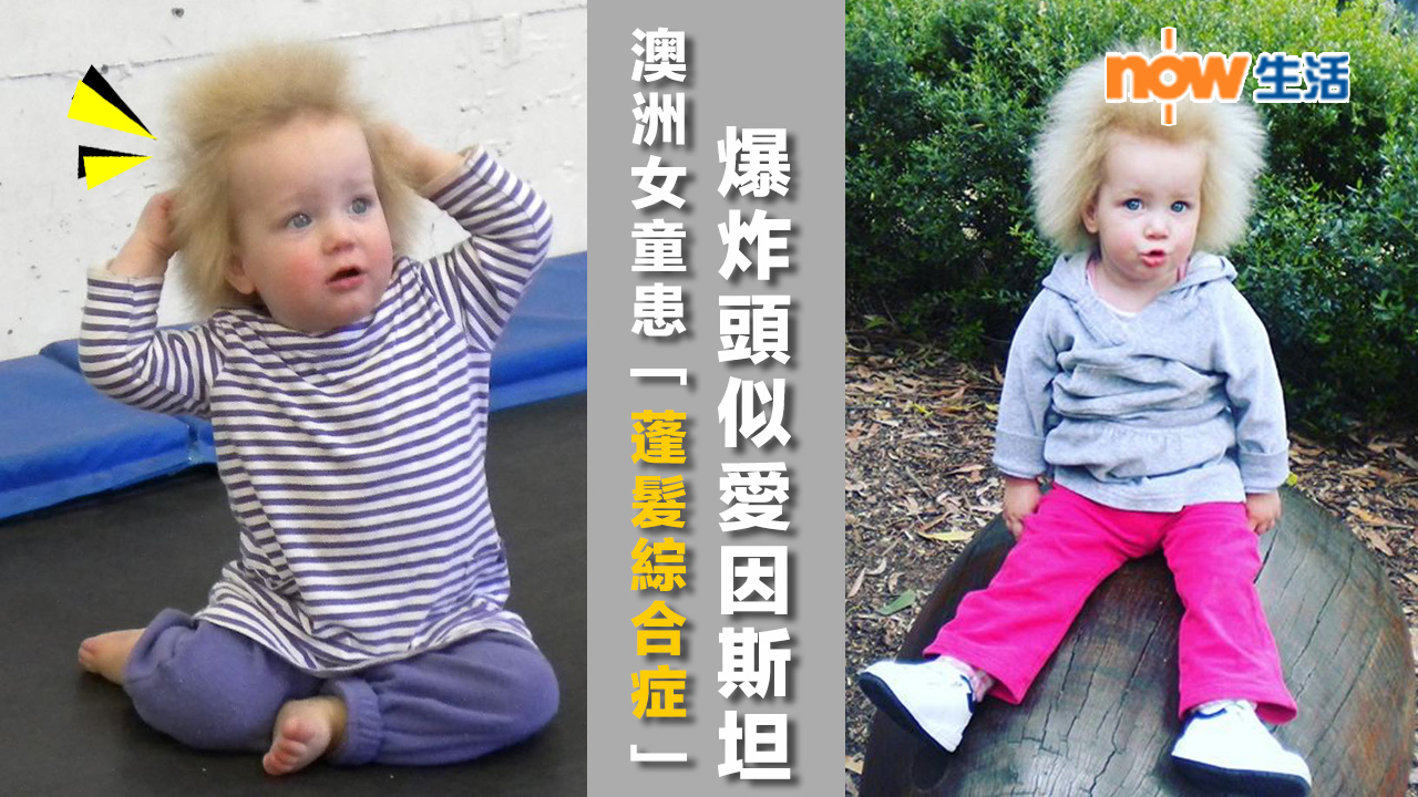 澳洲女童患「蓬髮綜合症」爆炸頭似愛因斯坦