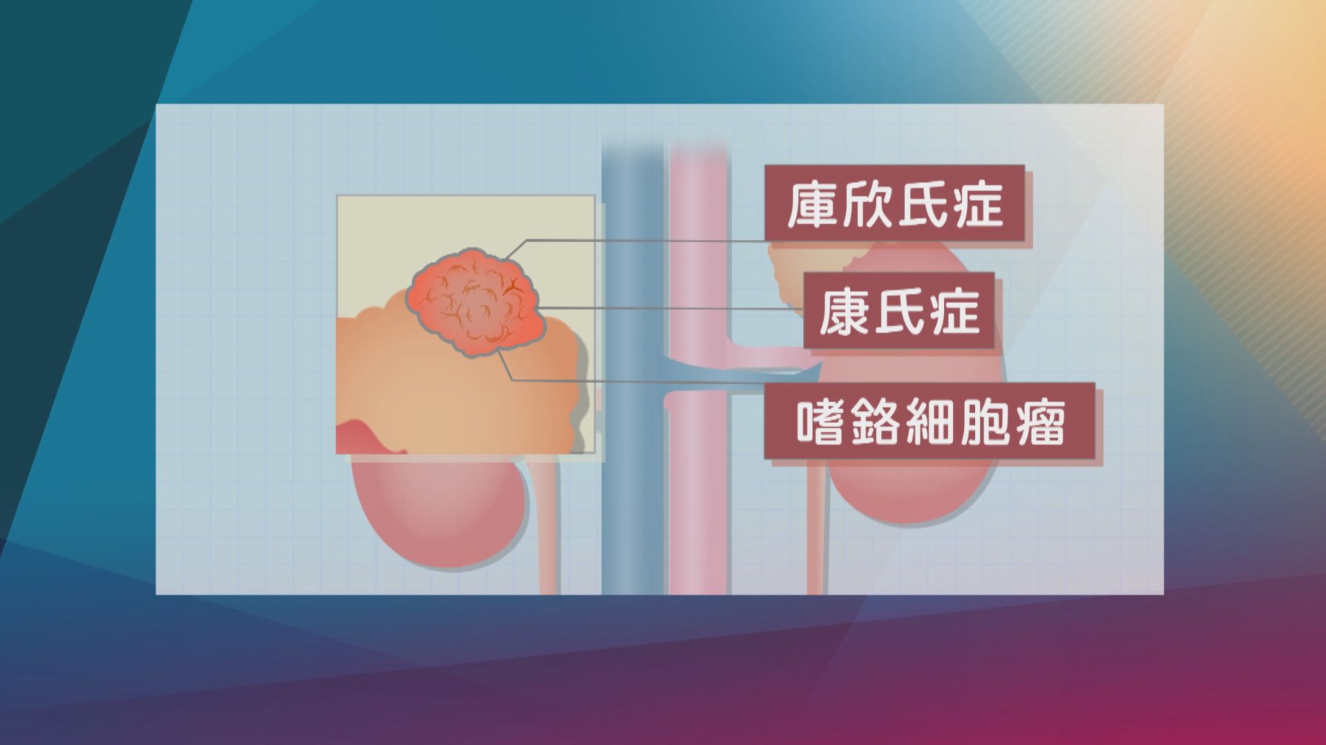 【杏林在線】腎上腺瘤與荷爾蒙失調