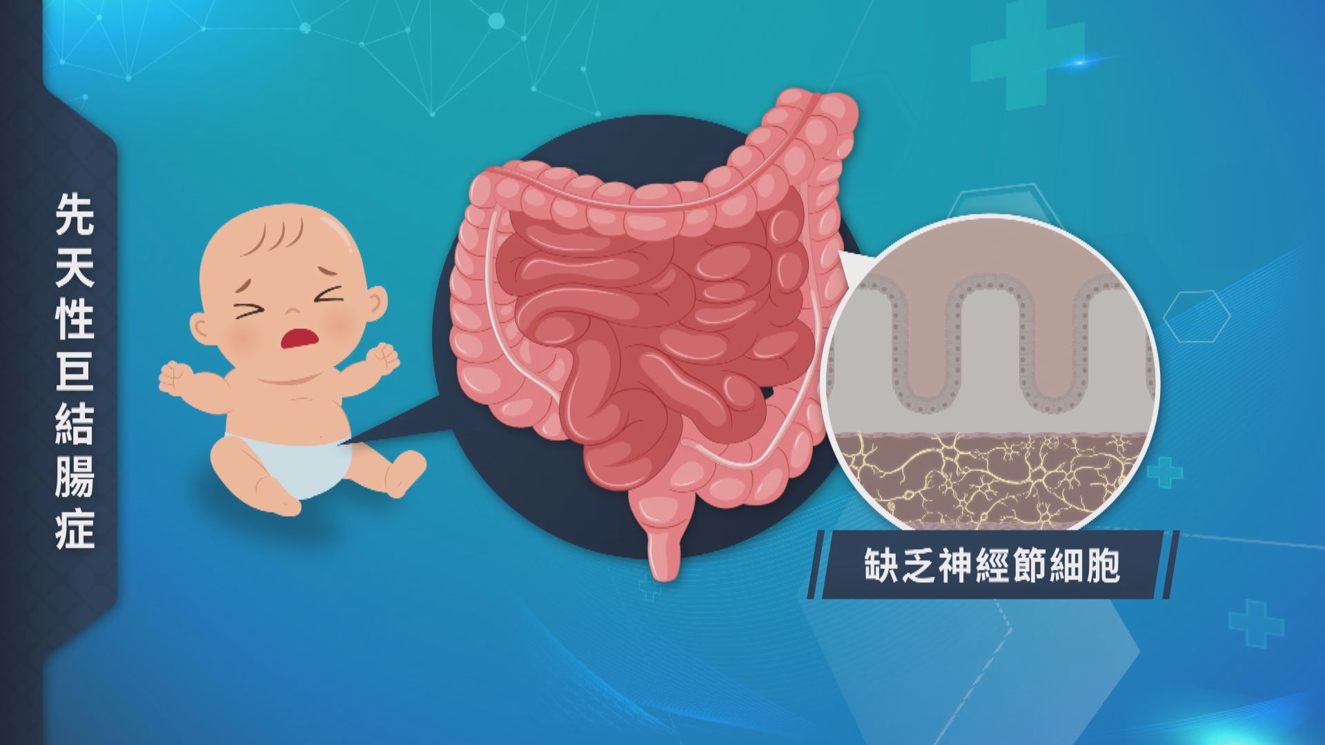 【杏林在線】腸黏連導致腸塞