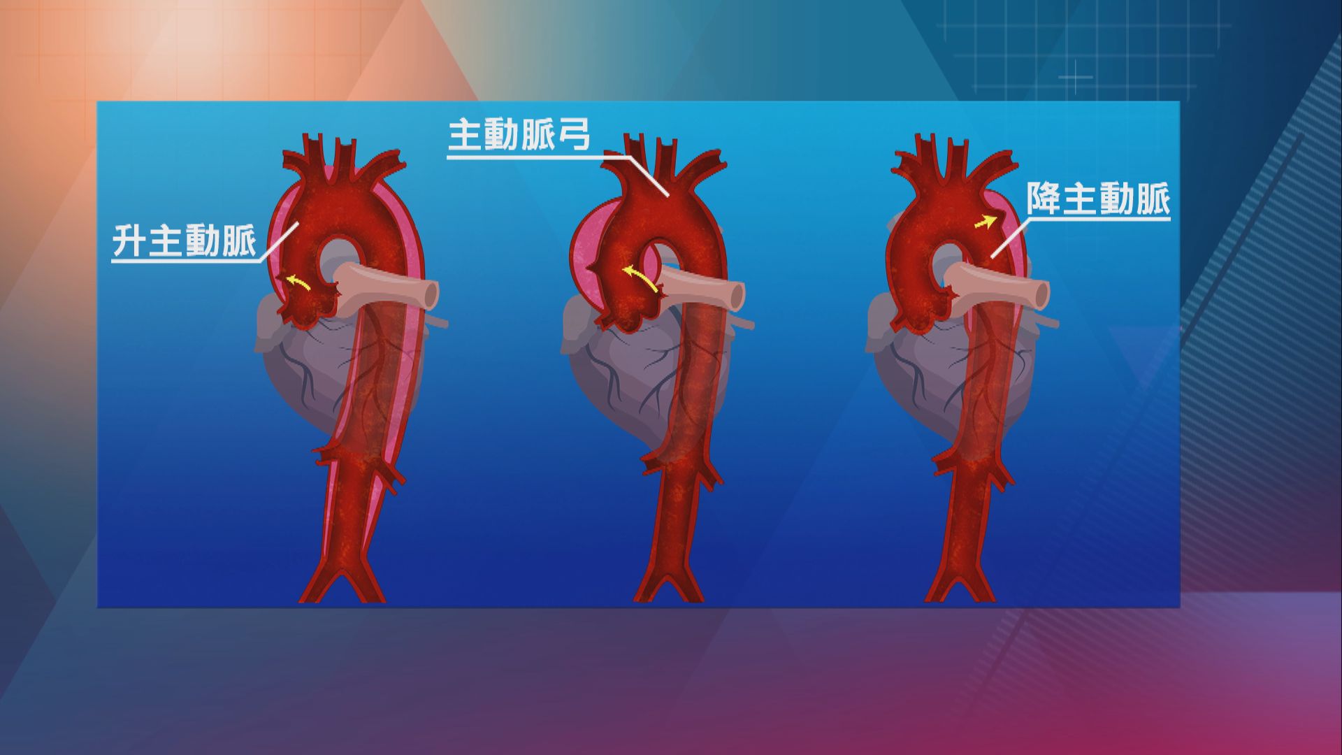 【杏林在線】主動脈「無聲殺手」