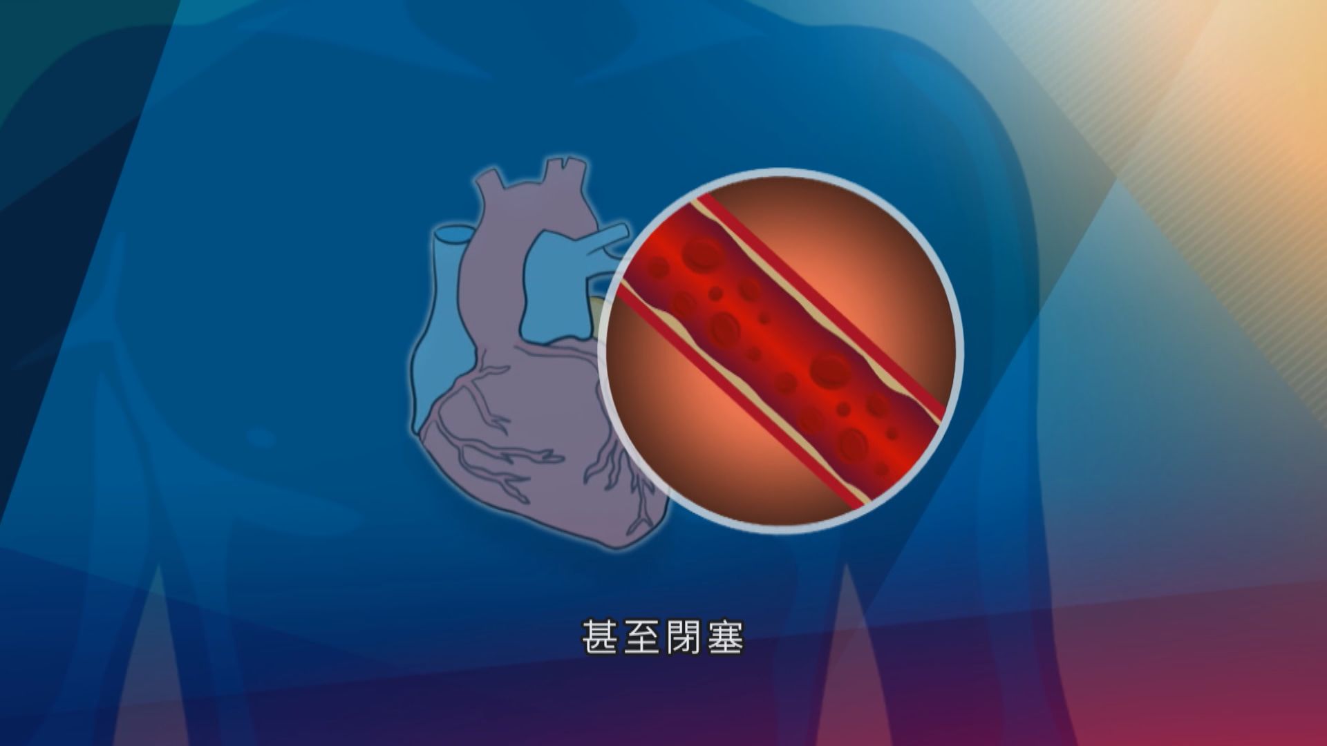 【杏林在線】鈣化的心臟血管