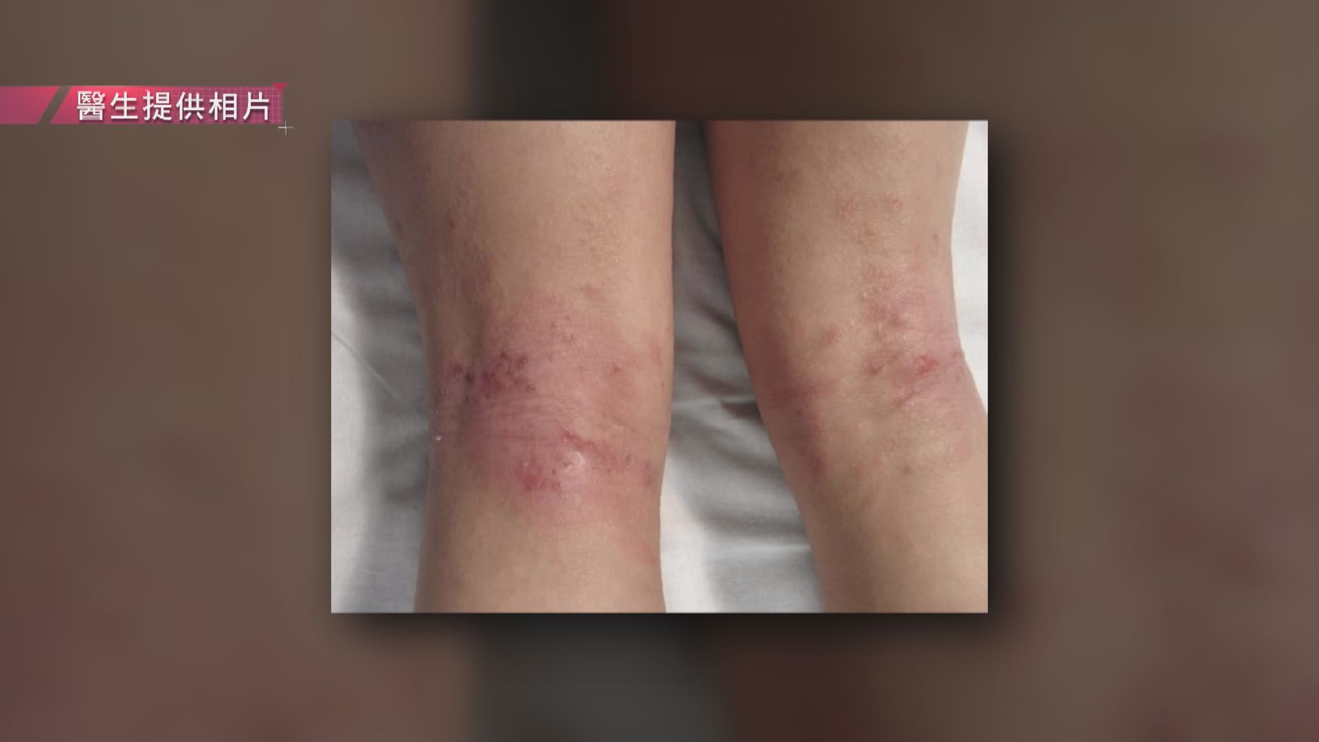 【杏林在線】兒童濕疹護理