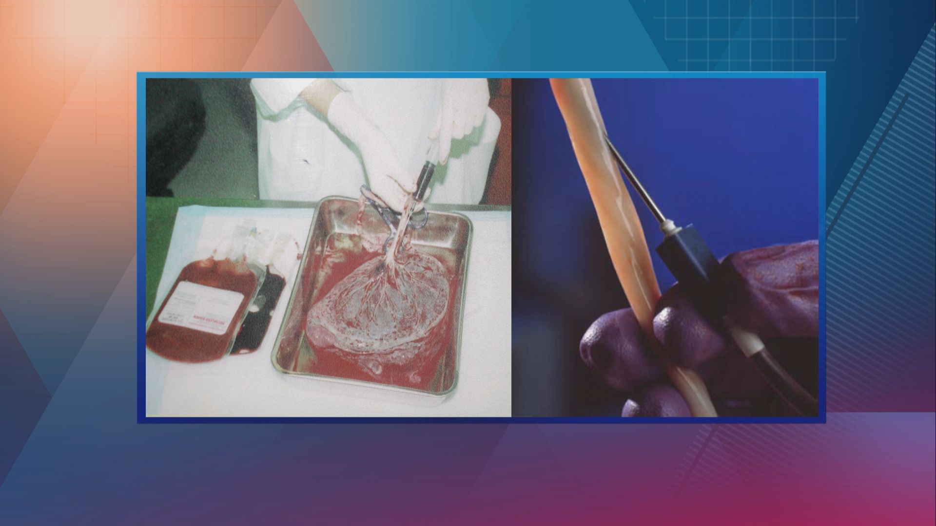 【杏林在線】 臍帶血有用嗎？