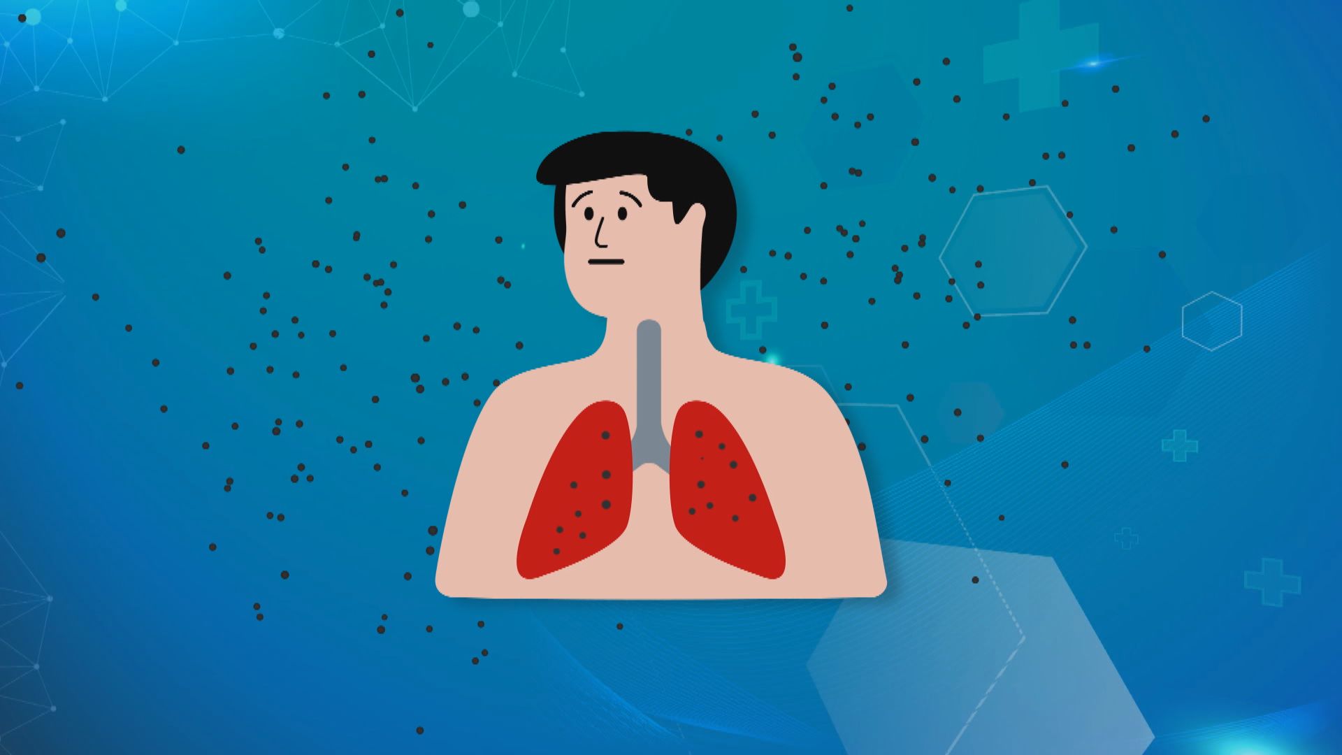 【杏林在線】肺塵埃沉著病