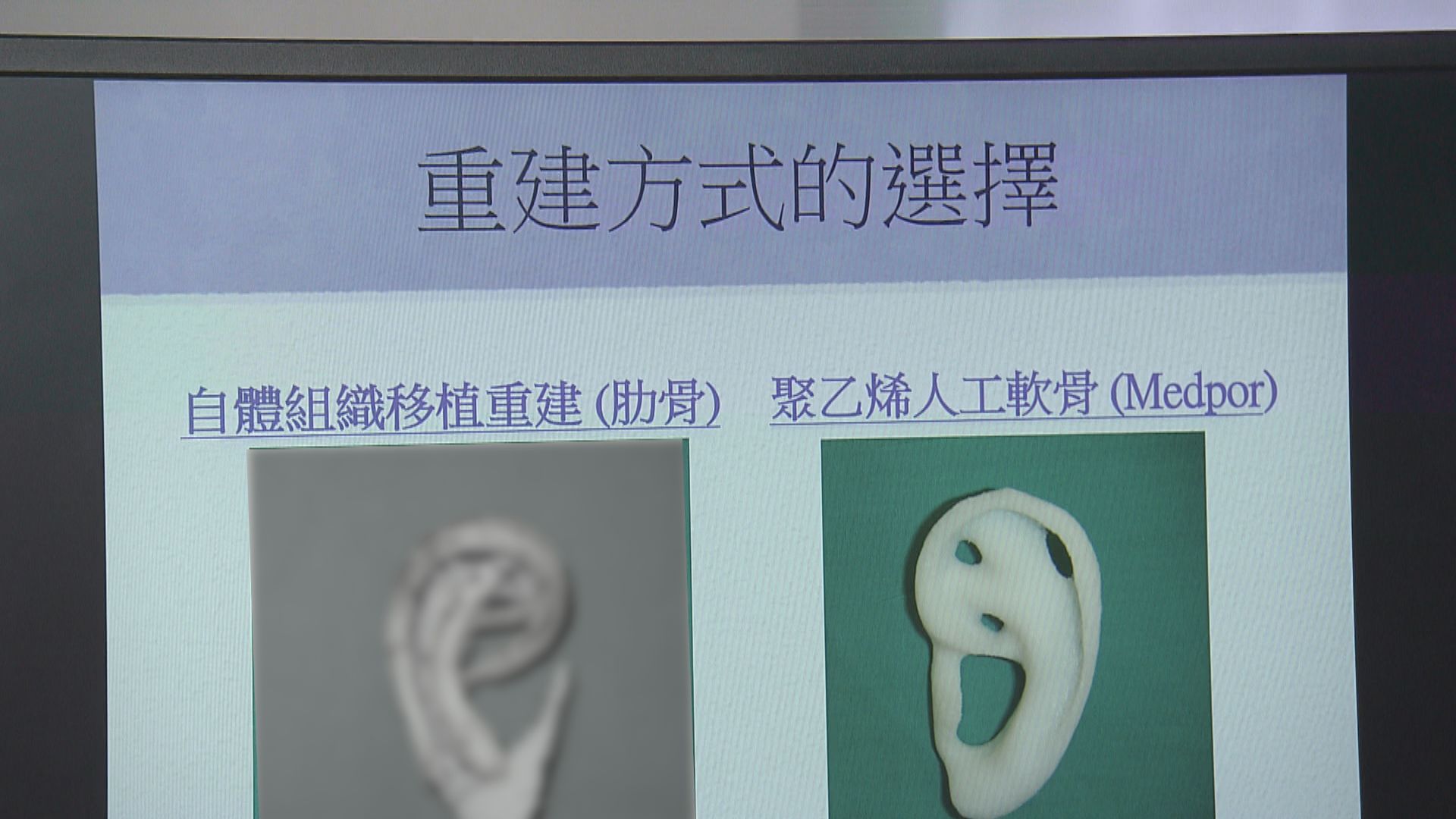 【杏林在線】我的新耳朵