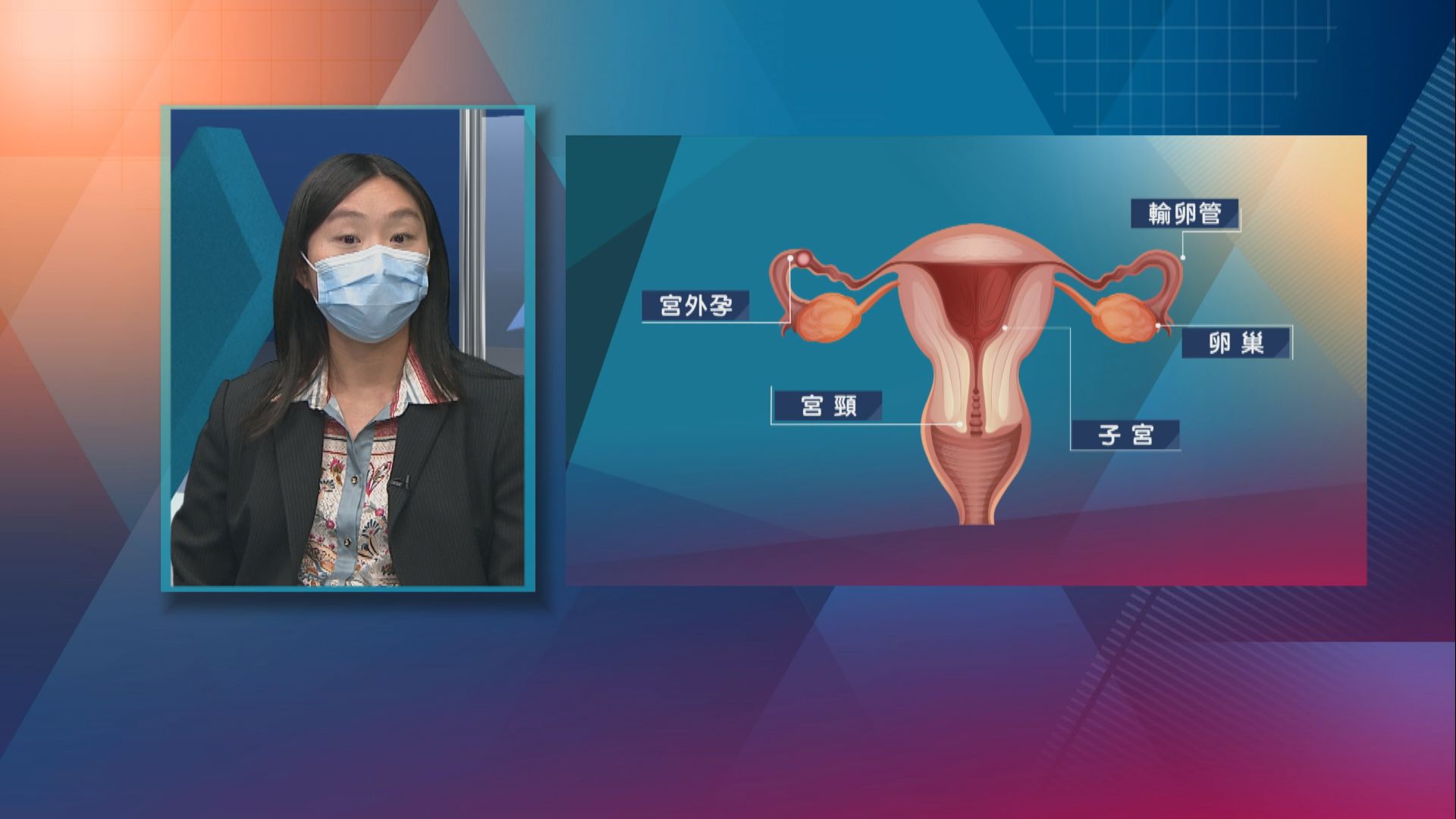 【杏林在線】子宮外的胚胎