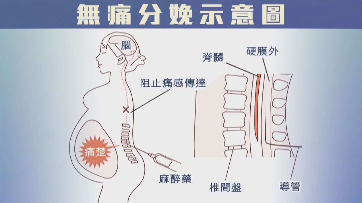 【杏林在線】無痛分娩