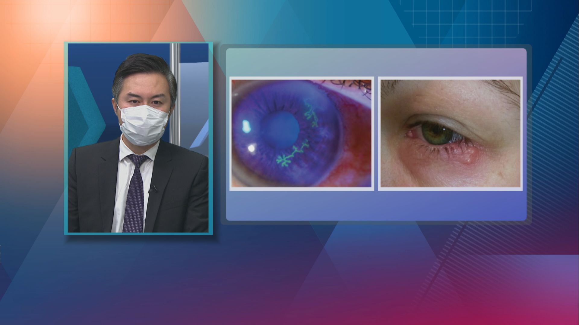 【杏林在線】皰疹上眼要注意