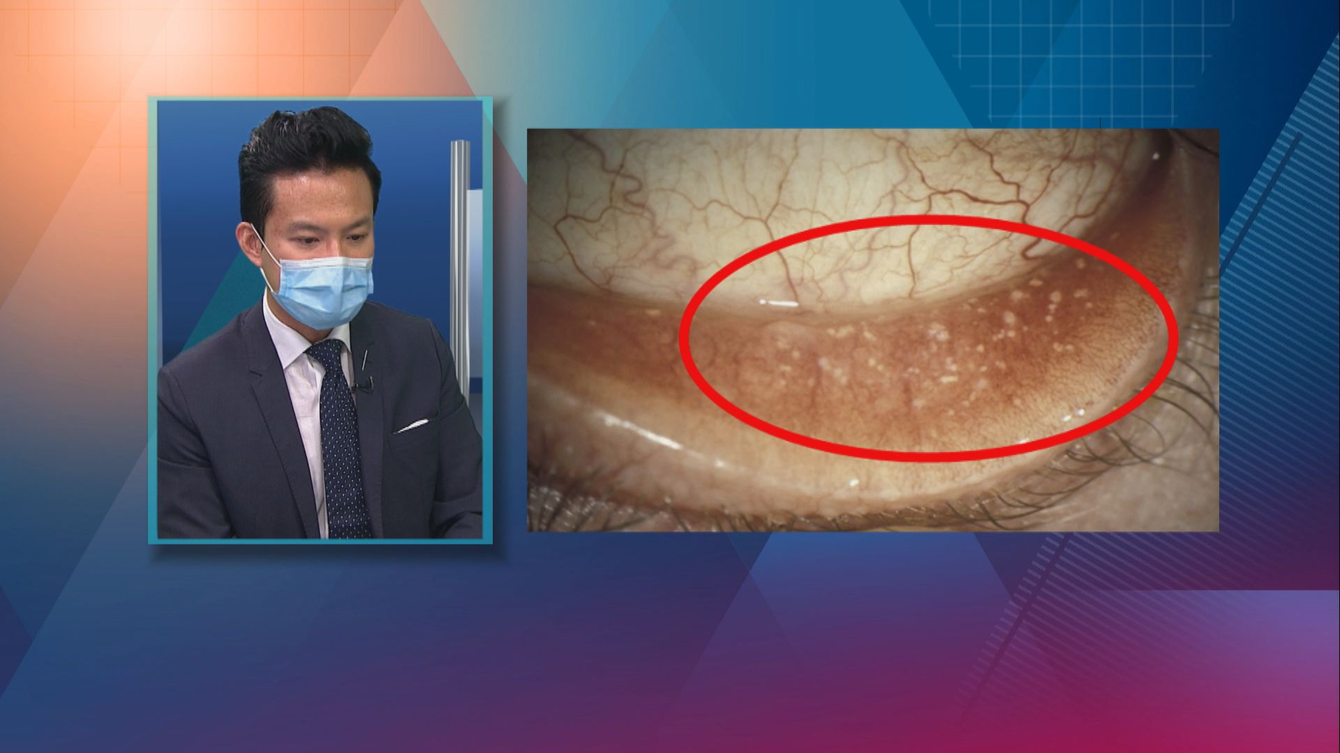 【杏林在線】眼睛的沙石