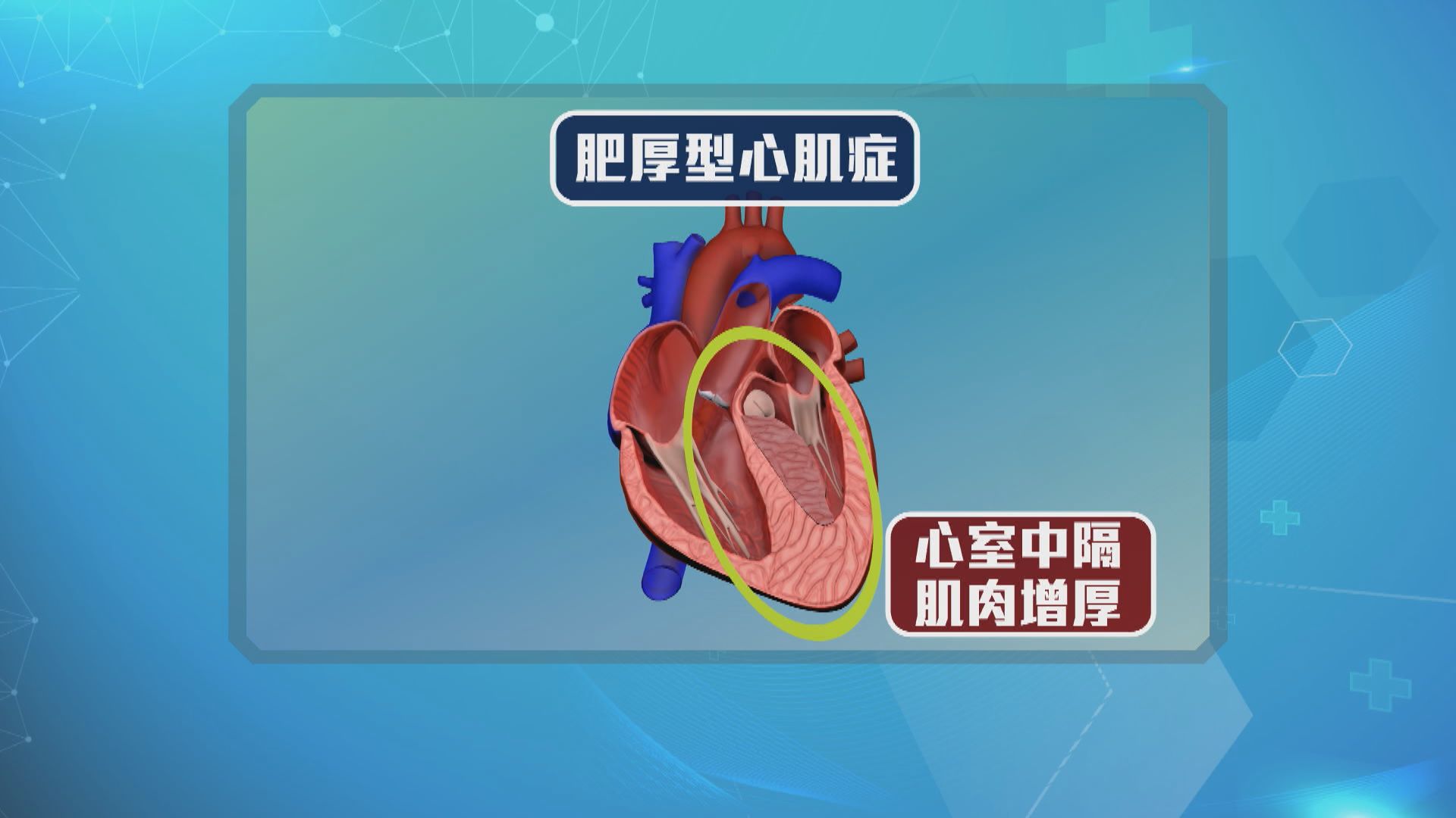 【杏林在線】肥厚的心