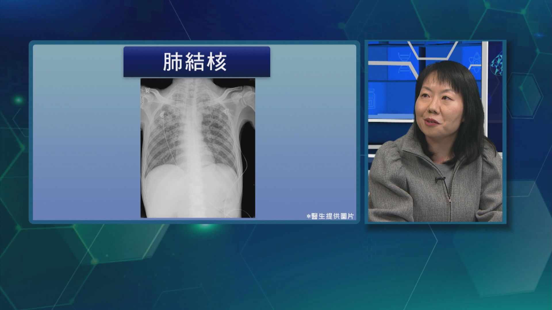 日本人字牌救心呈獻：杏林在線｜肺結核治療新趨勢