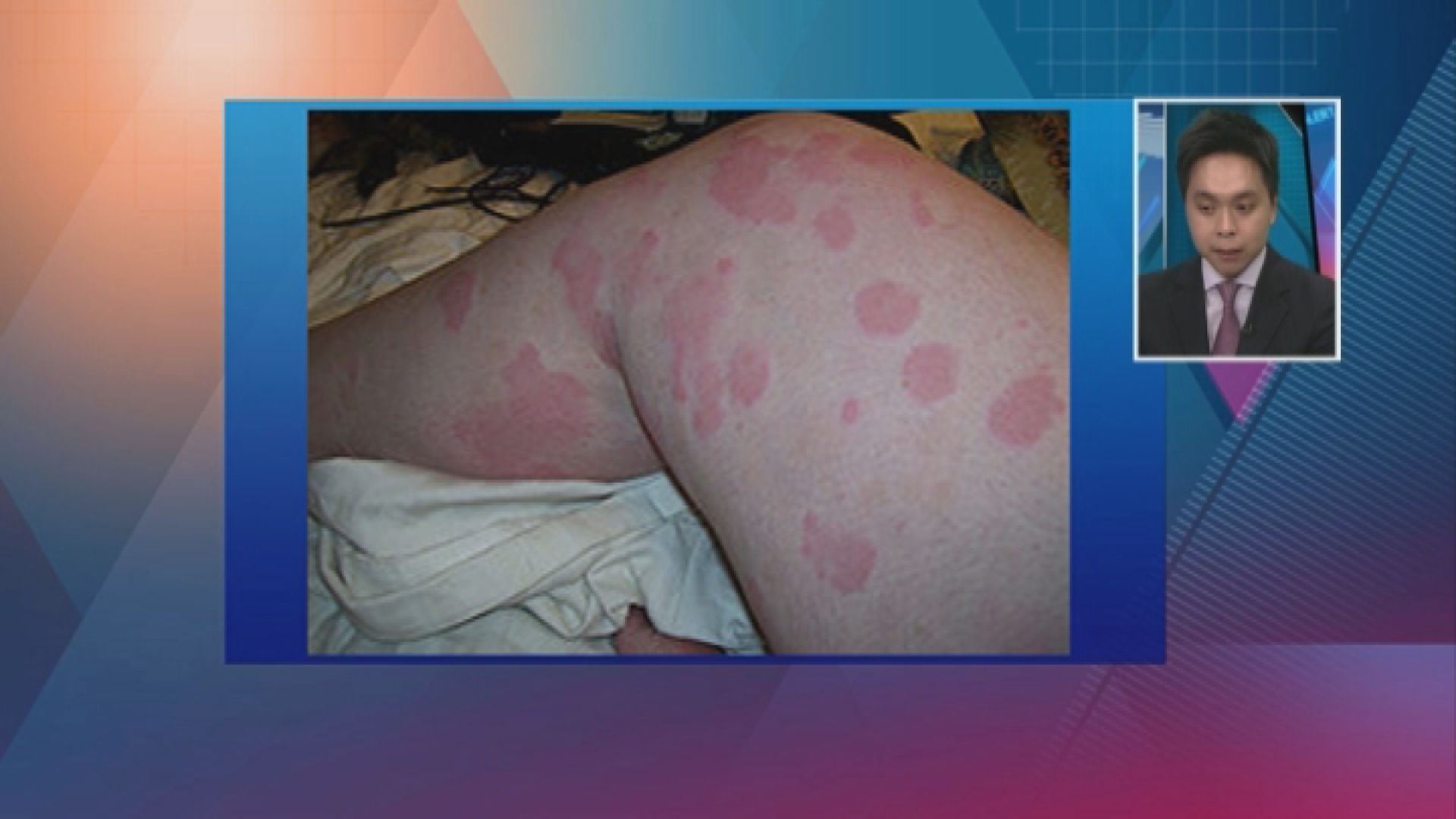 【杏林在線】風癩來襲