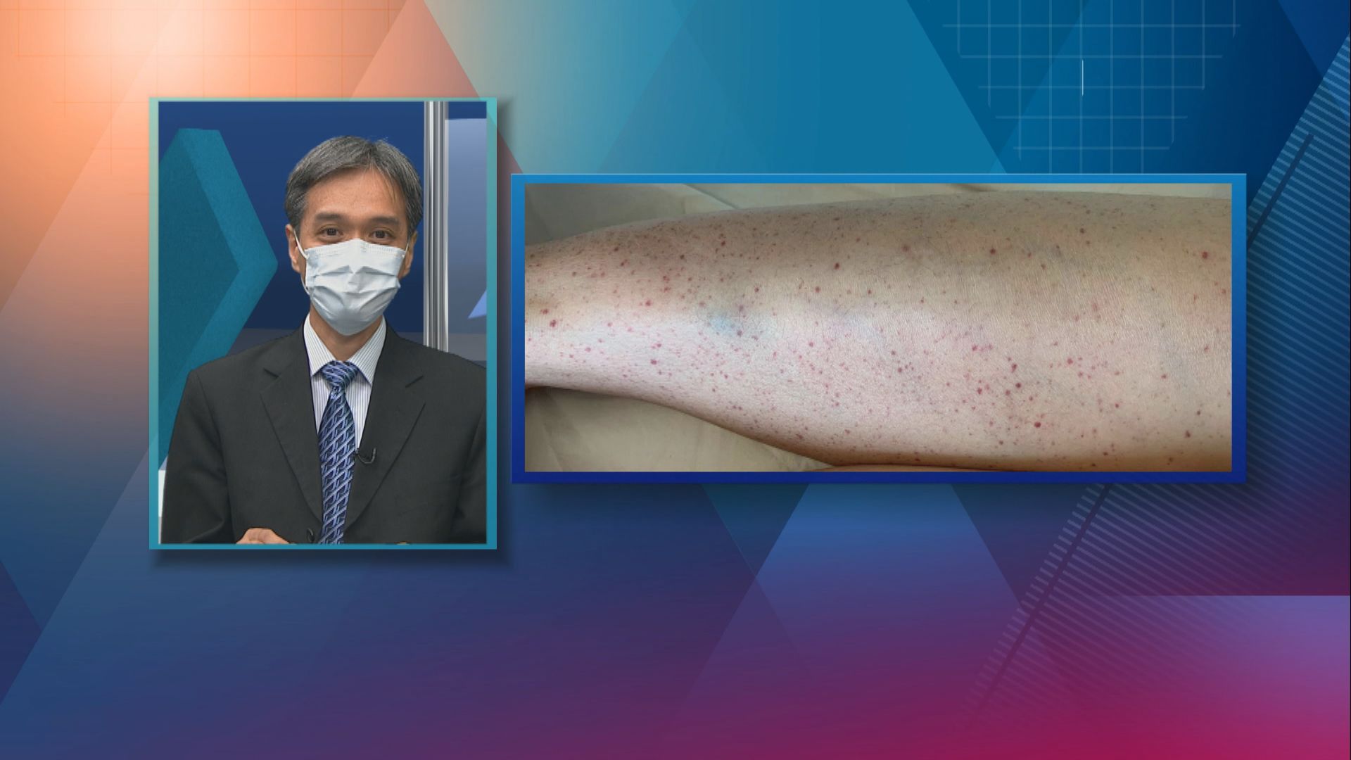 【杏林在線】皮膚上的紫斑