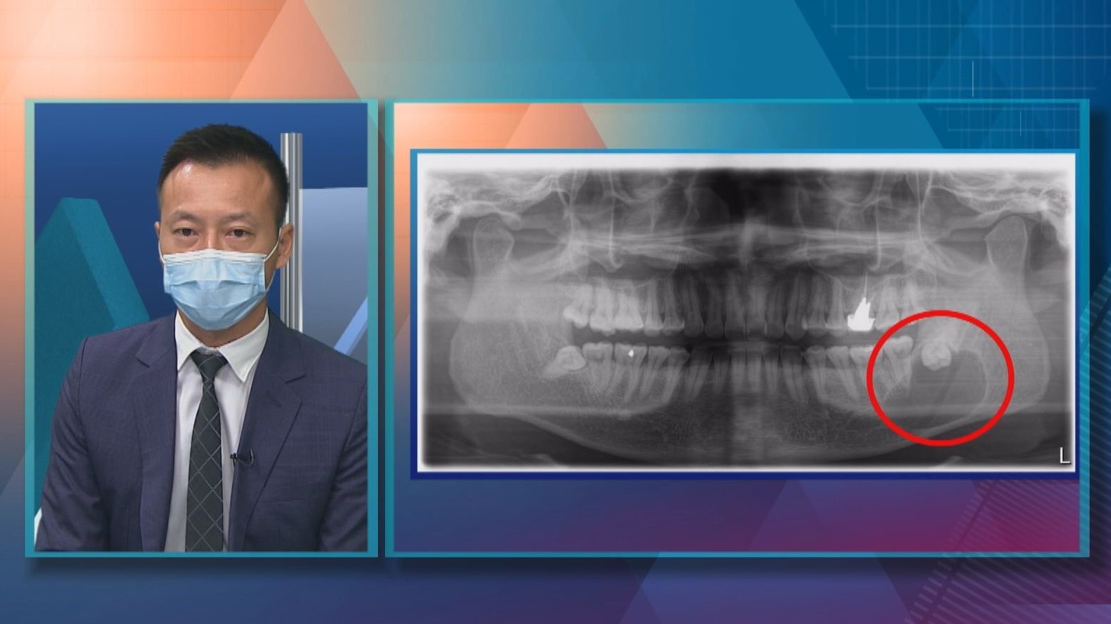 【杏林在線】認識顎骨囊腫