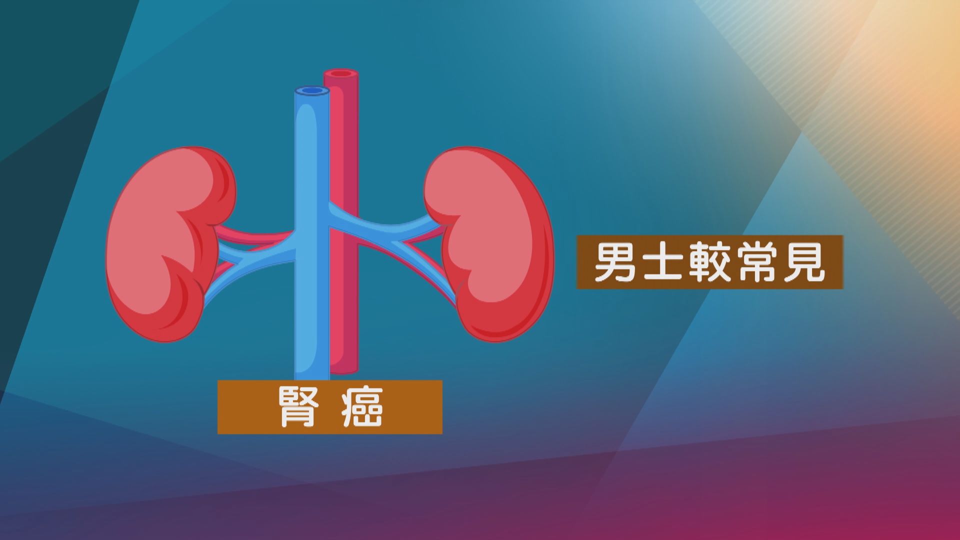 【杏林在線】不易察覺的腎癌