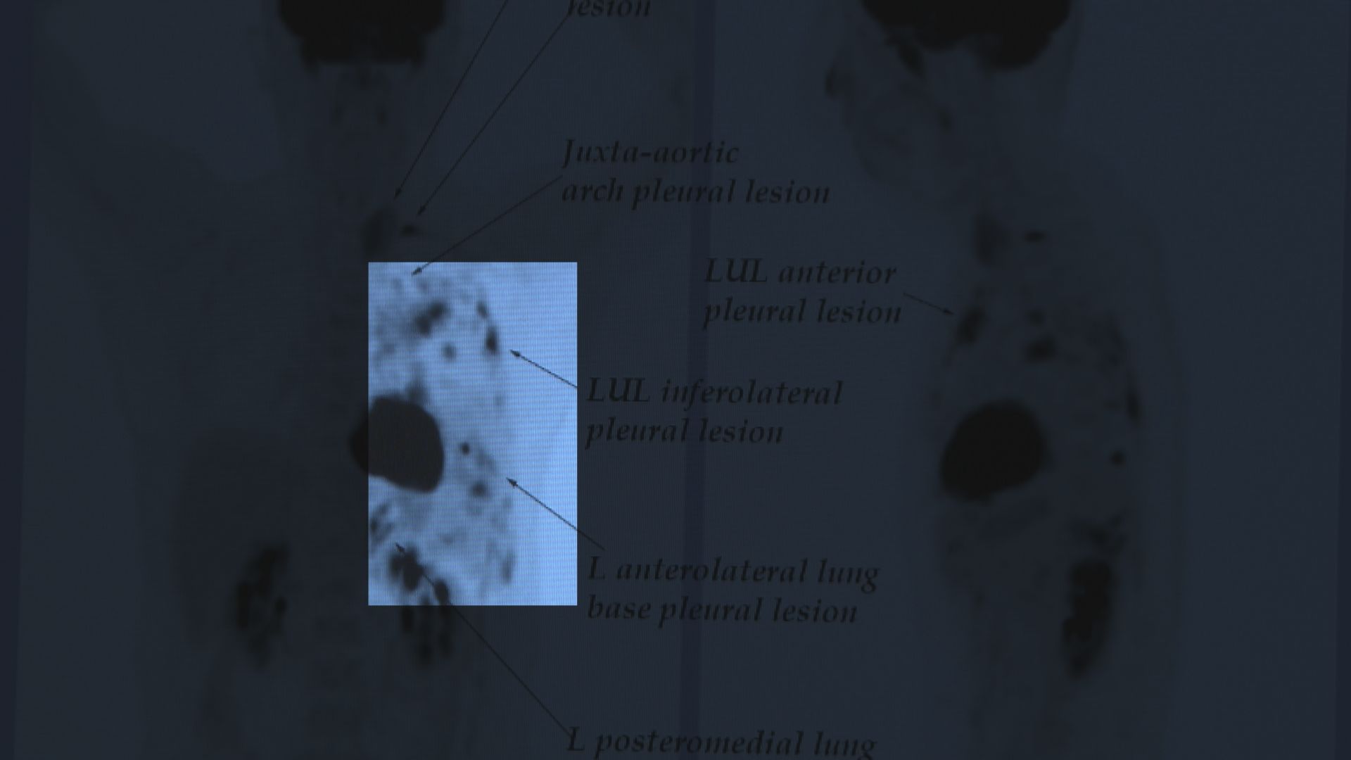 【杏林在線】只有十六人患上的癌症