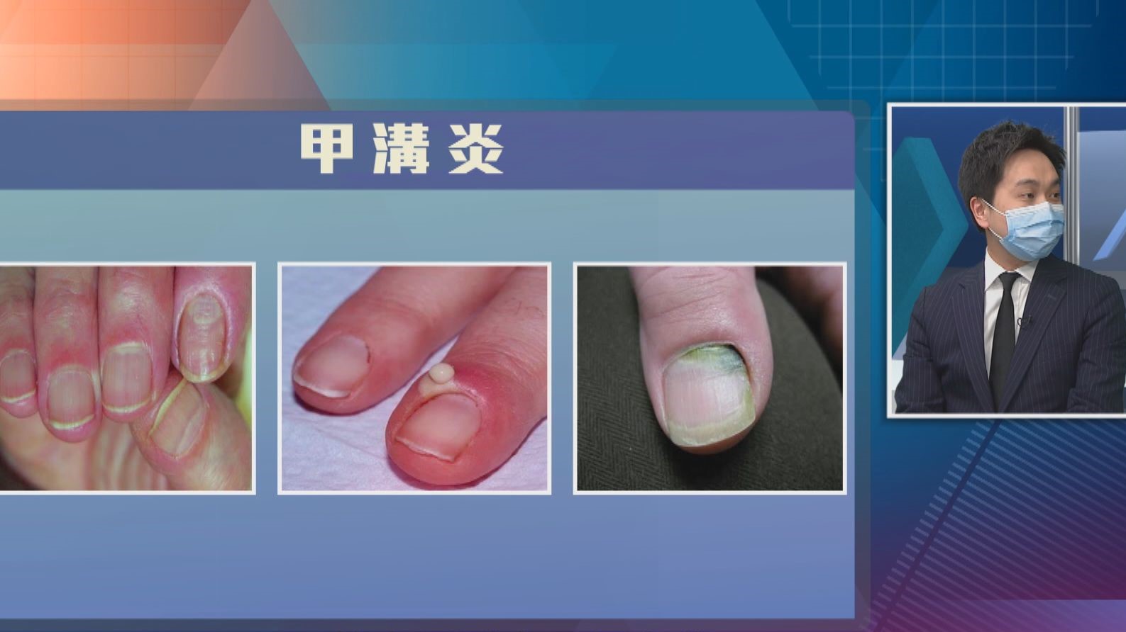 【杏林在線】慎防甲溝炎