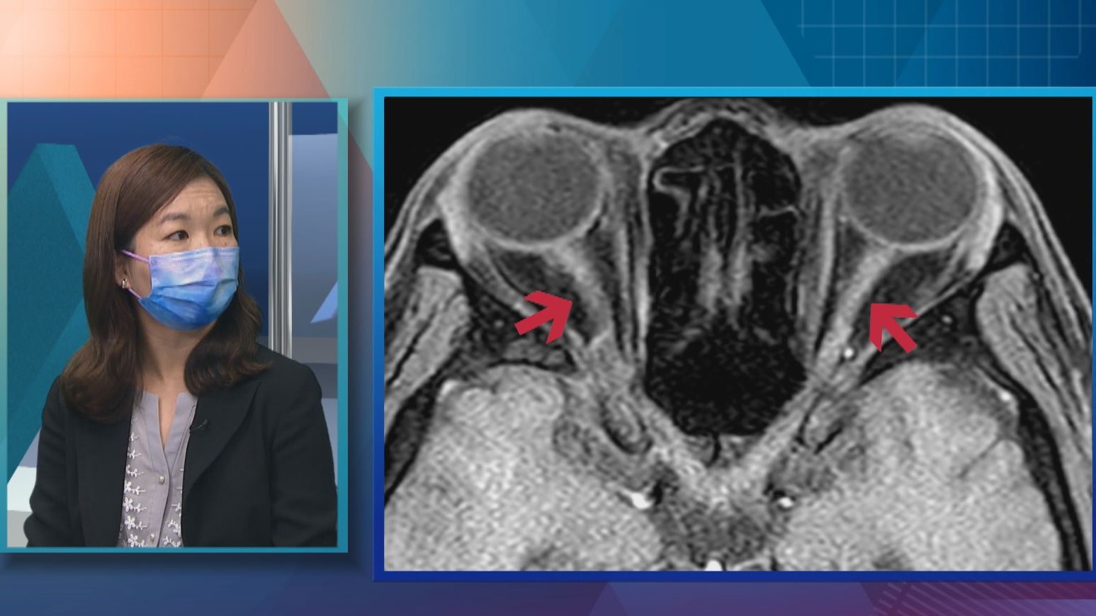 【杏林在線】視神經發炎