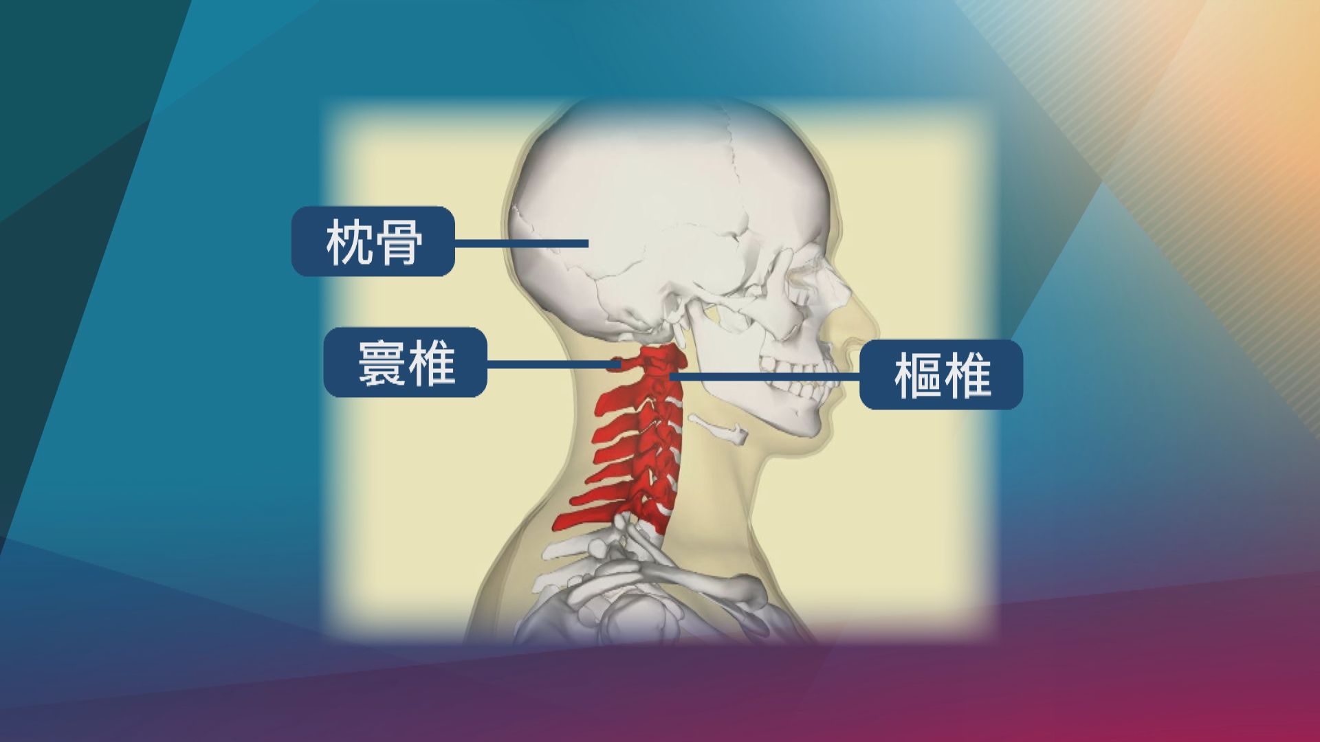 【杏林在線】慎防寰樞椎旋轉脫位