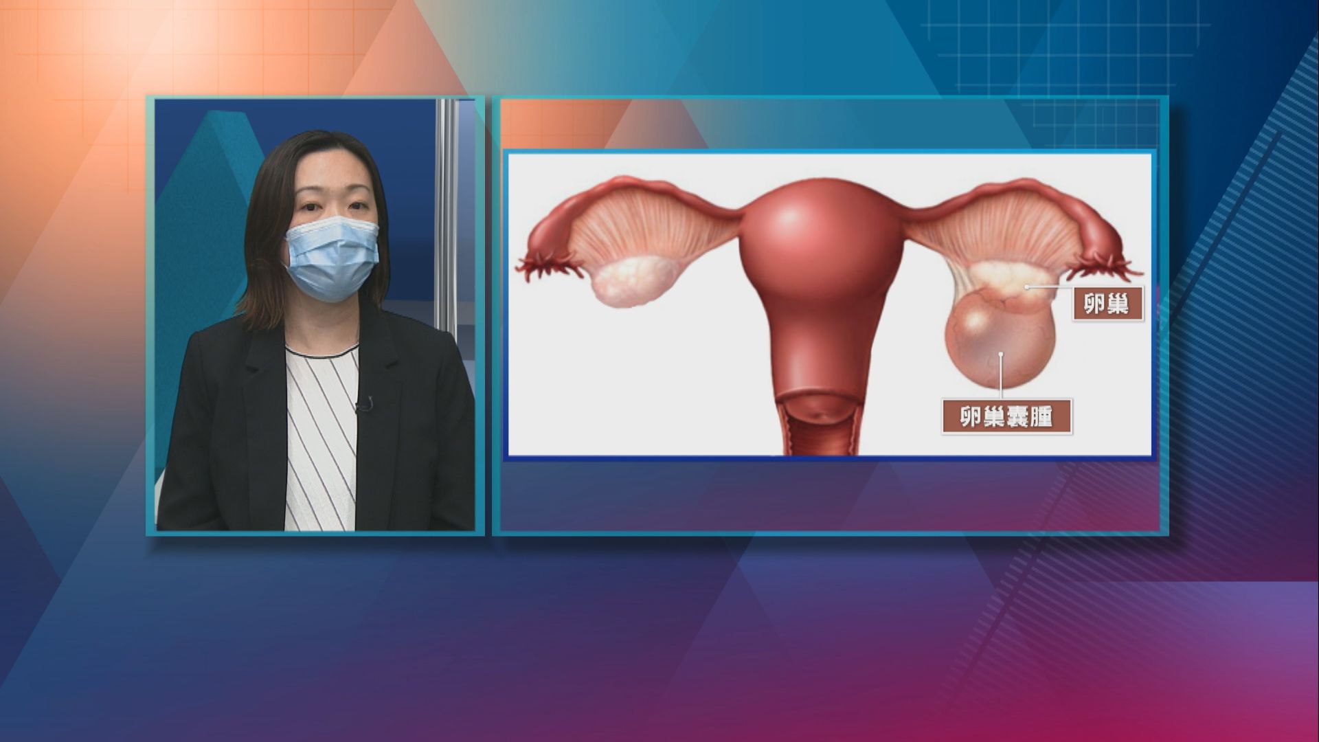 【杏林在線】甚麼是卵巢囊腫？