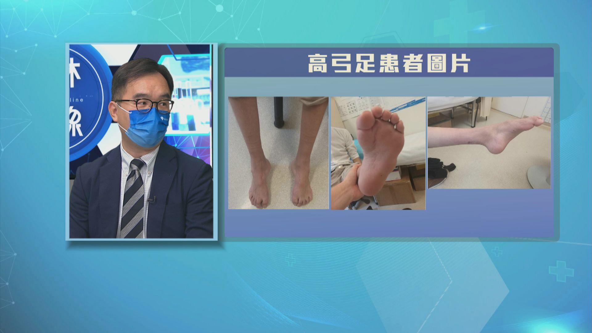 【杏林在線】高弓足