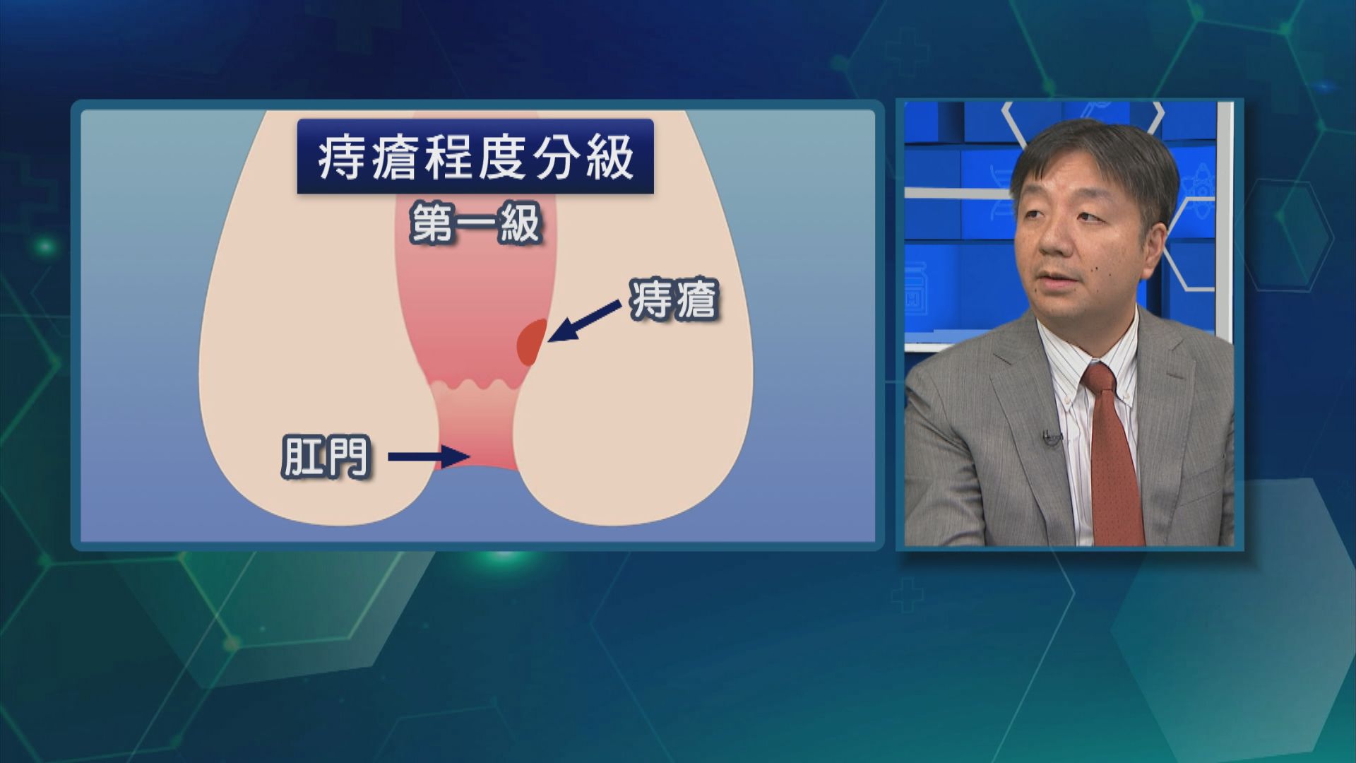杏林在線｜久坐馬桶易長痔瘡？