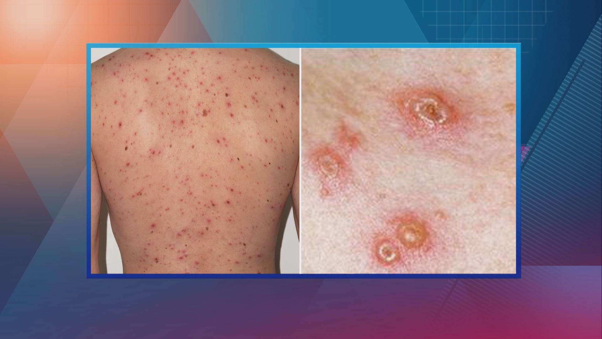 【杏林在線】出水痘怎麼辦？