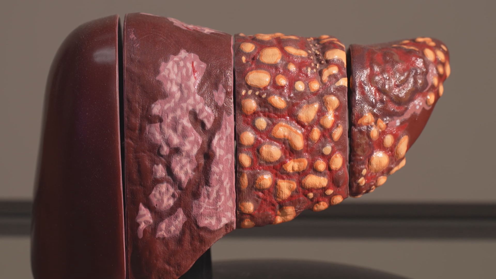 杏林在線｜慢性殺手(一)：逆轉脂肪肝