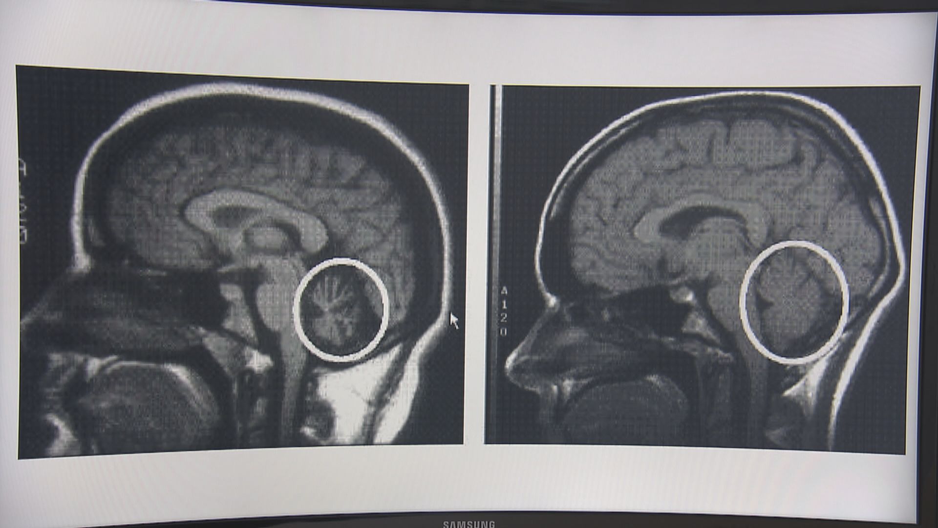 【杏林在線】萎縮的小腦