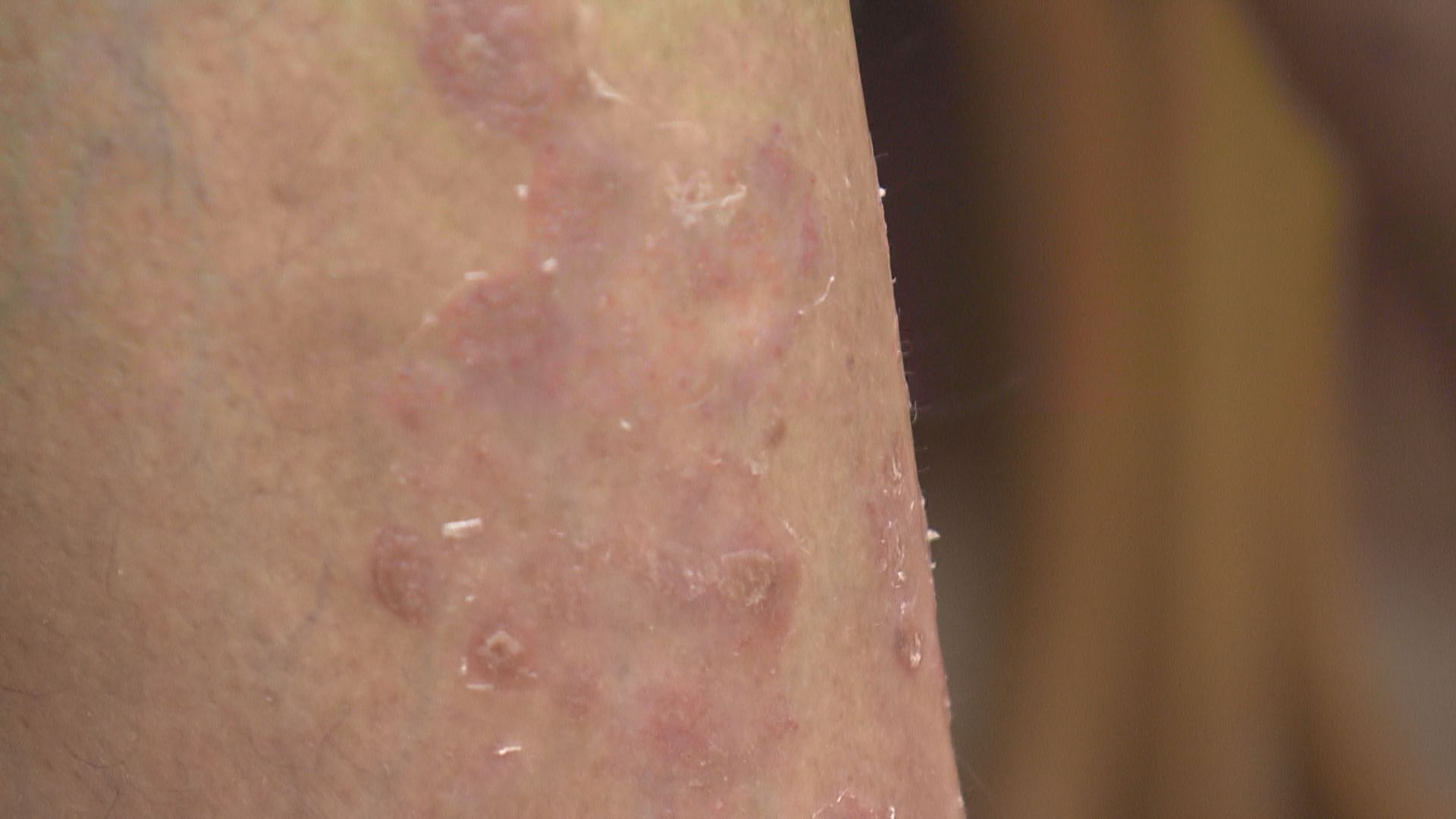 【杏林在線】銀色皮屑