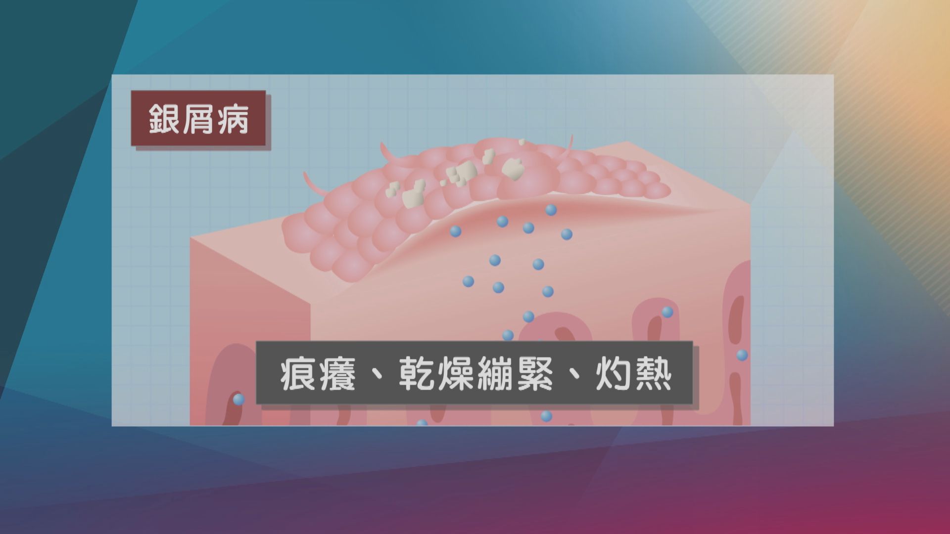 【杏林在線】銀屑背後