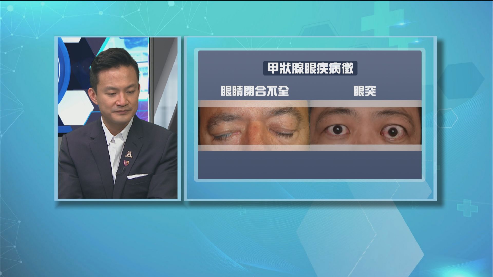 【杏林在線】甲狀腺上眼