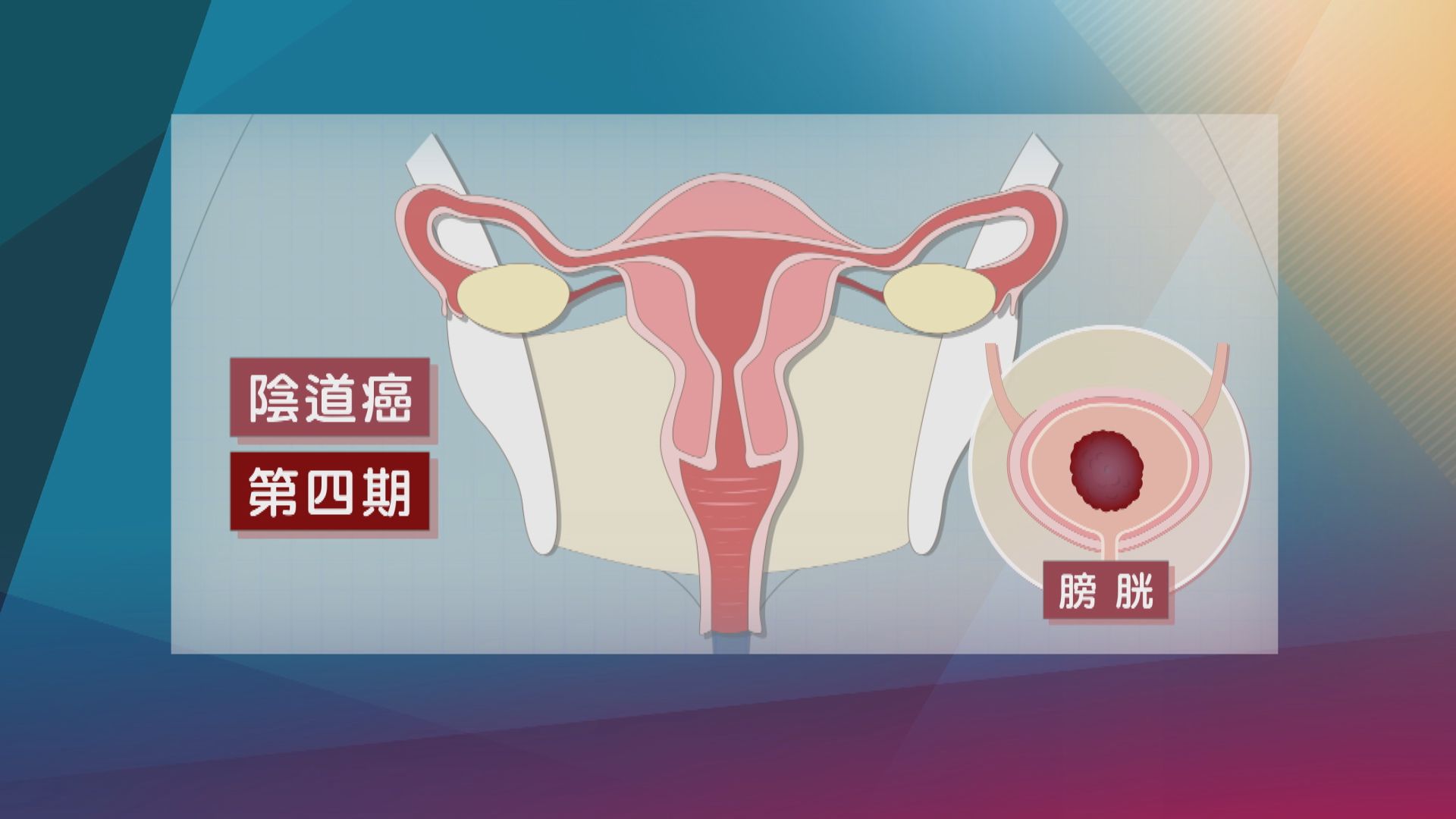 【杏林在線】陰道異常出血的危機