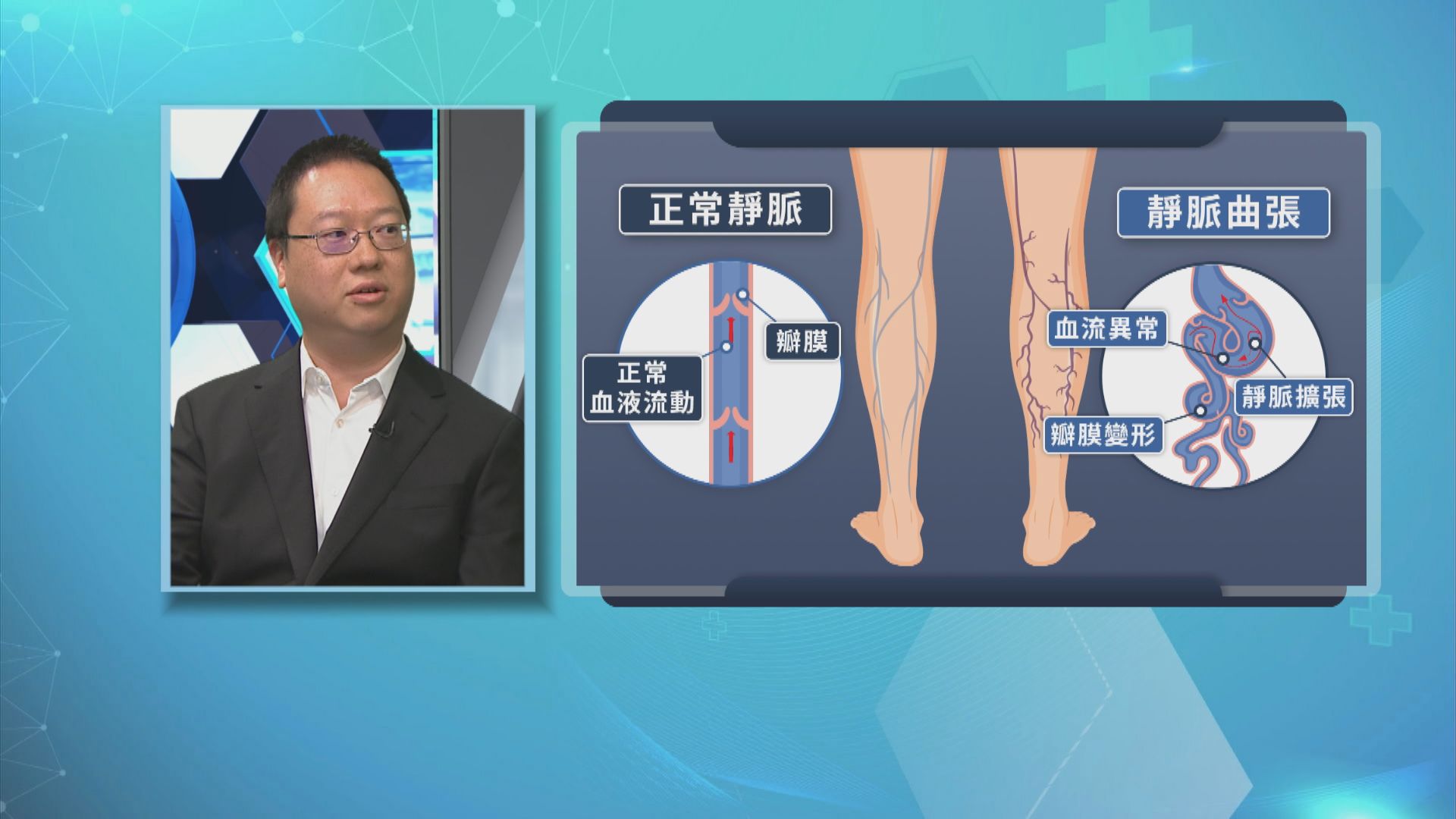 【杏林在線】靜脈曲張