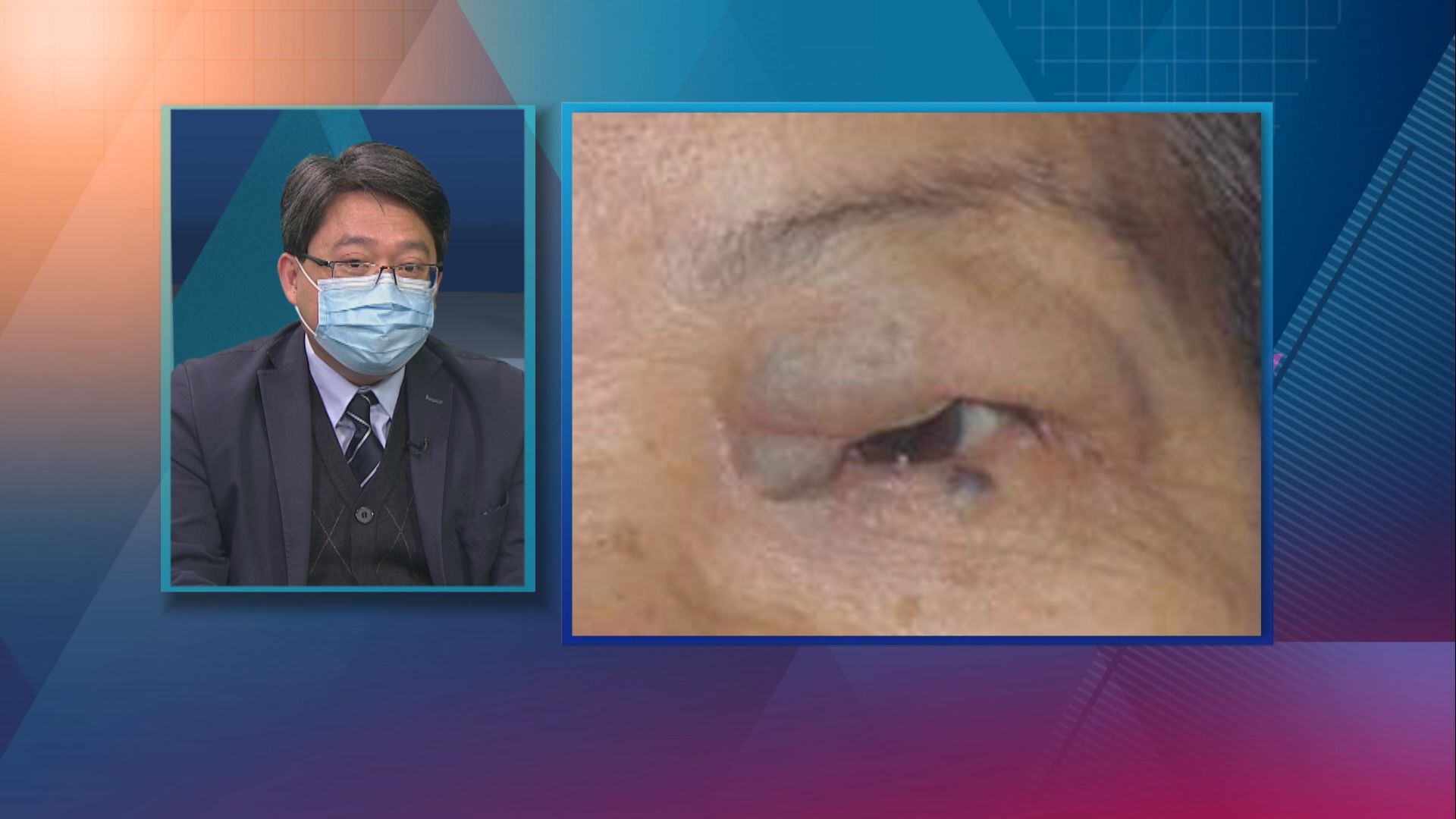 【杏林在線】忽然眼腫