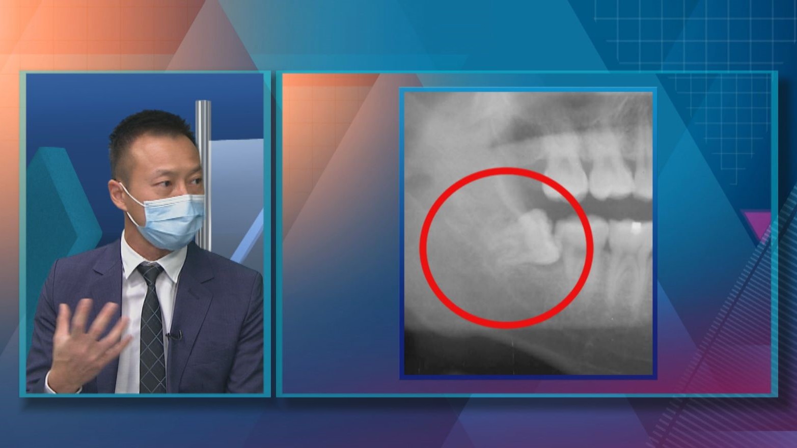 【杏林在線】拆解智慧齒的迷思