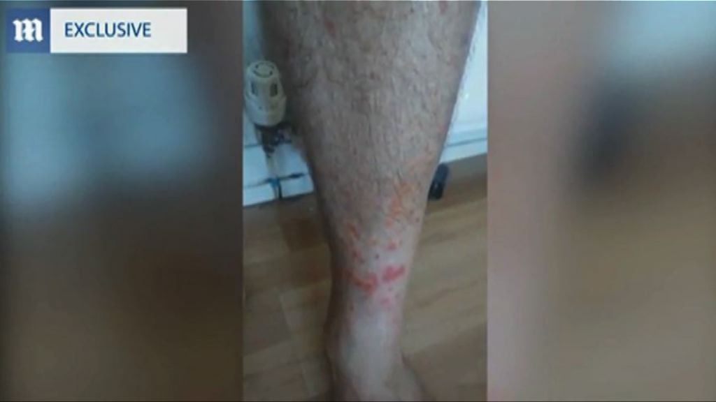 英航商務客位男子遭床蝨叮咬