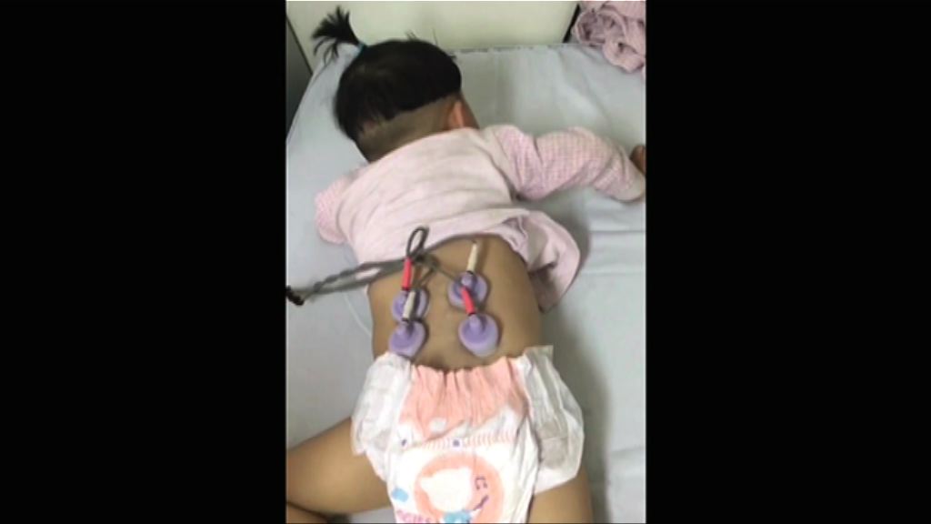 內地小童接種疫苗後癱瘓疑涉問題疫苗