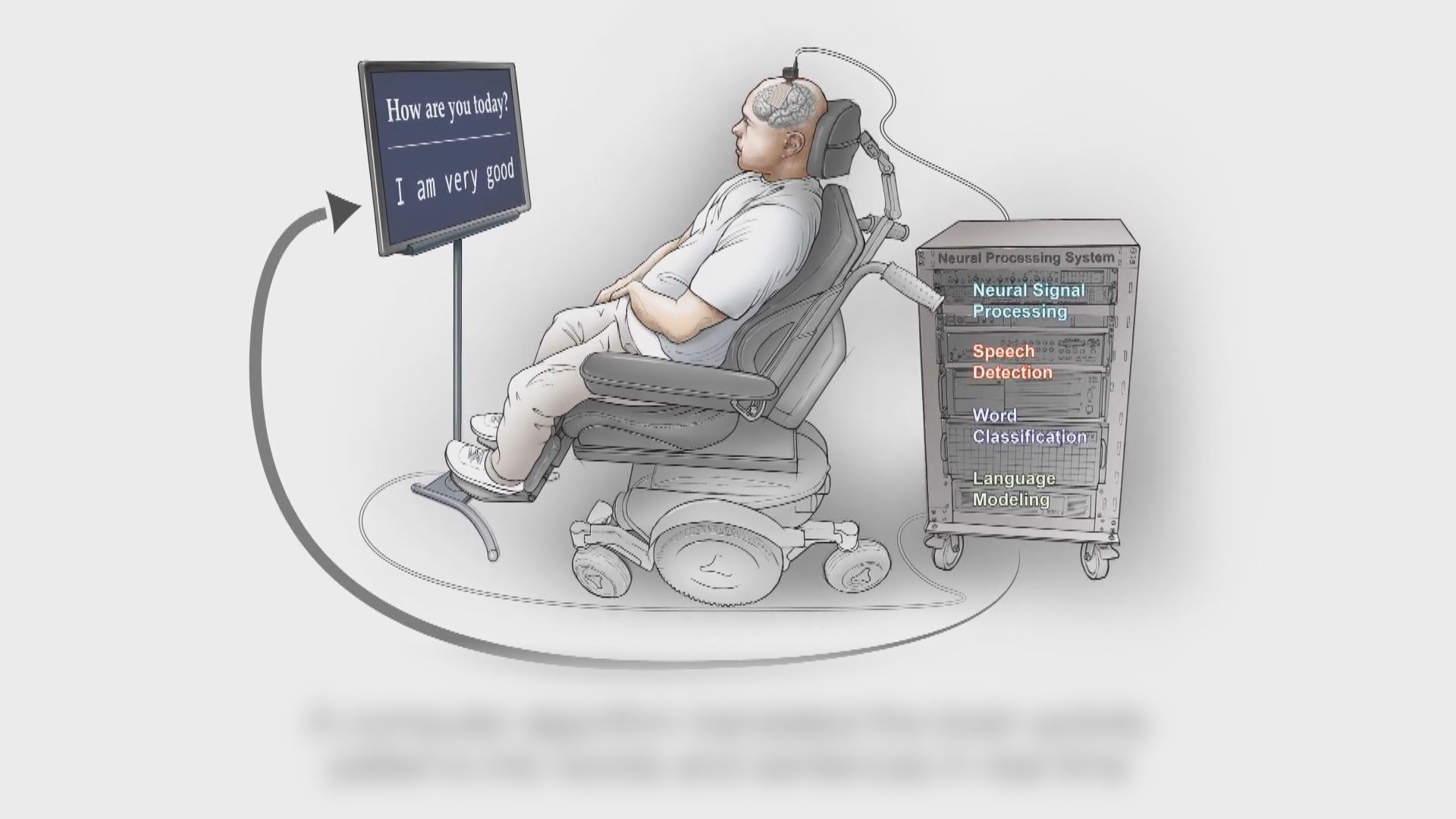 美研究冀助嚴重殘障人士重拾溝通能力