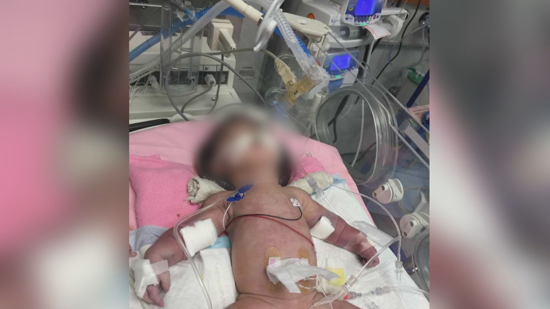 聯合醫院真空吸盤助產女嬰八天逝世　死因庭裁定死於不幸