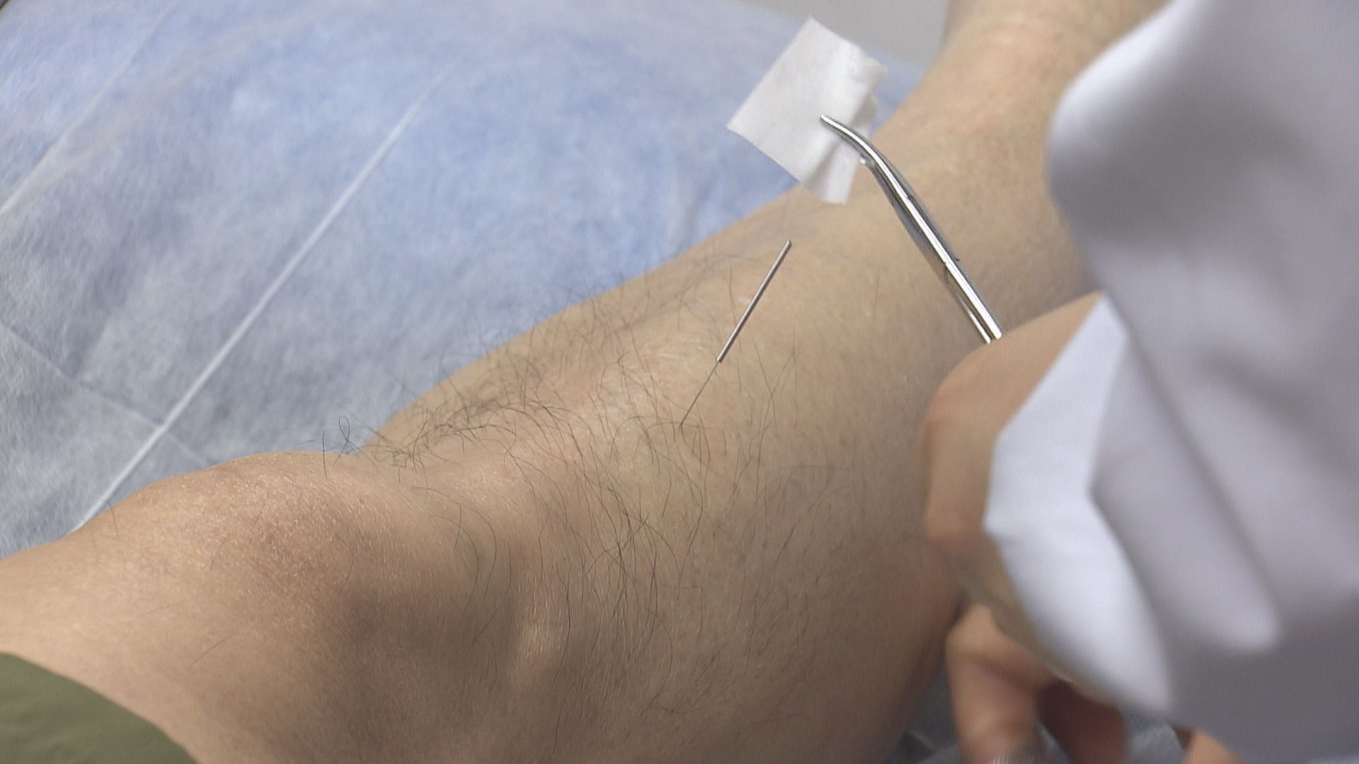 47歲男子針灸後感染食肉菌要截肢　涉事診所環境樣本驗出同類病菌